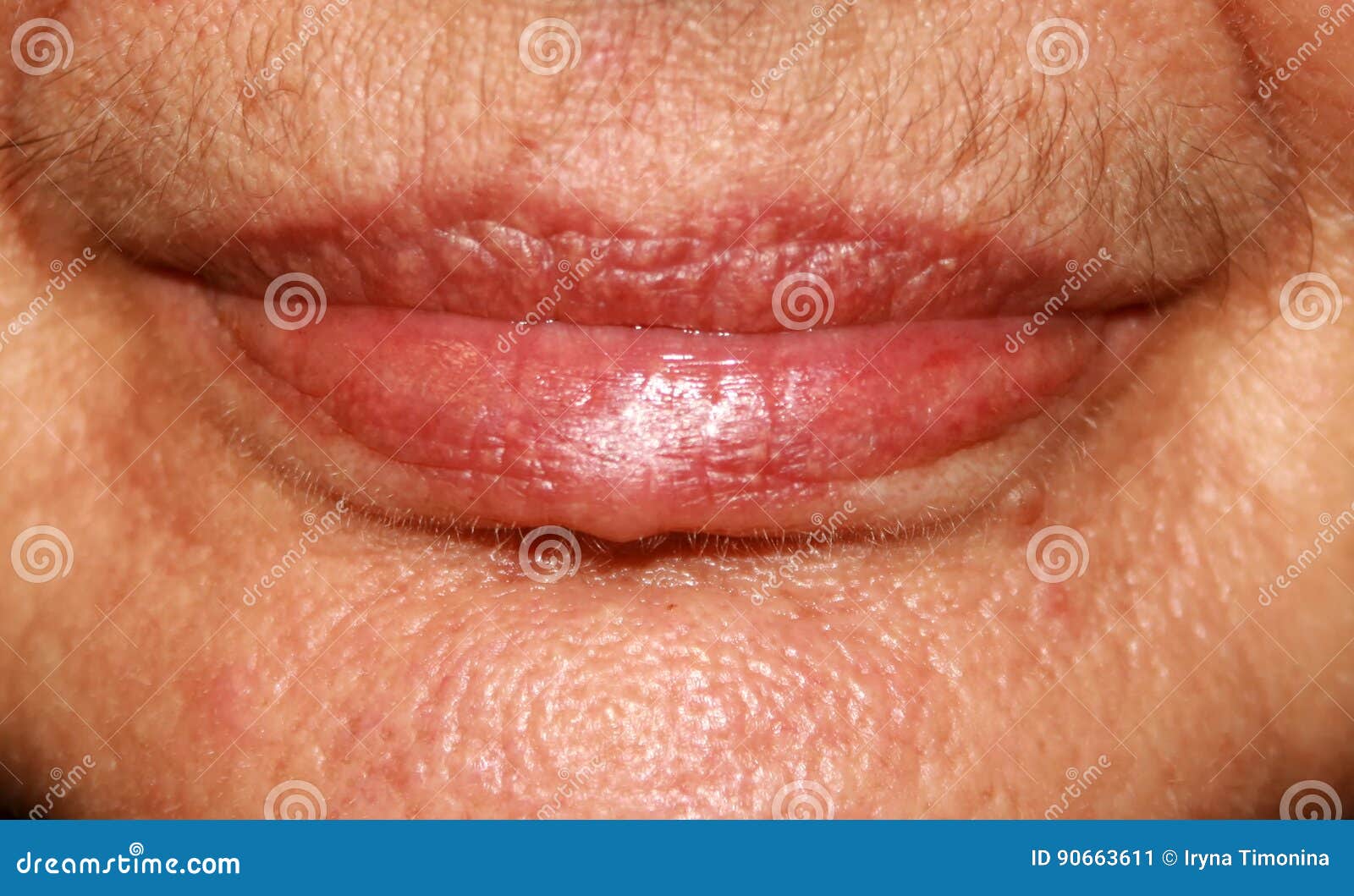 Lippen Silikon Nasolabialfalten Falten Um Den Mund Stockbild Bild Von Silikon Lippen