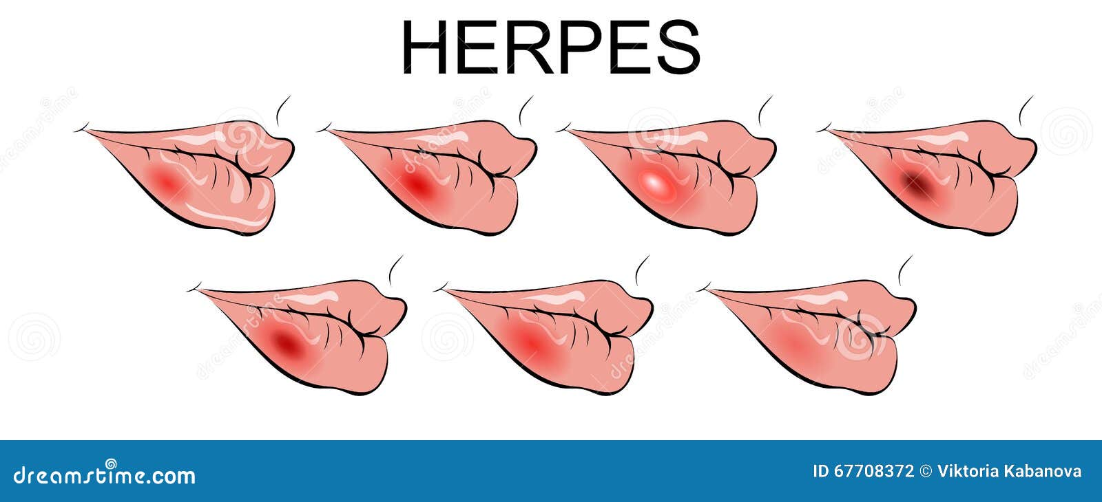 Herpes labialis - Wikipedia