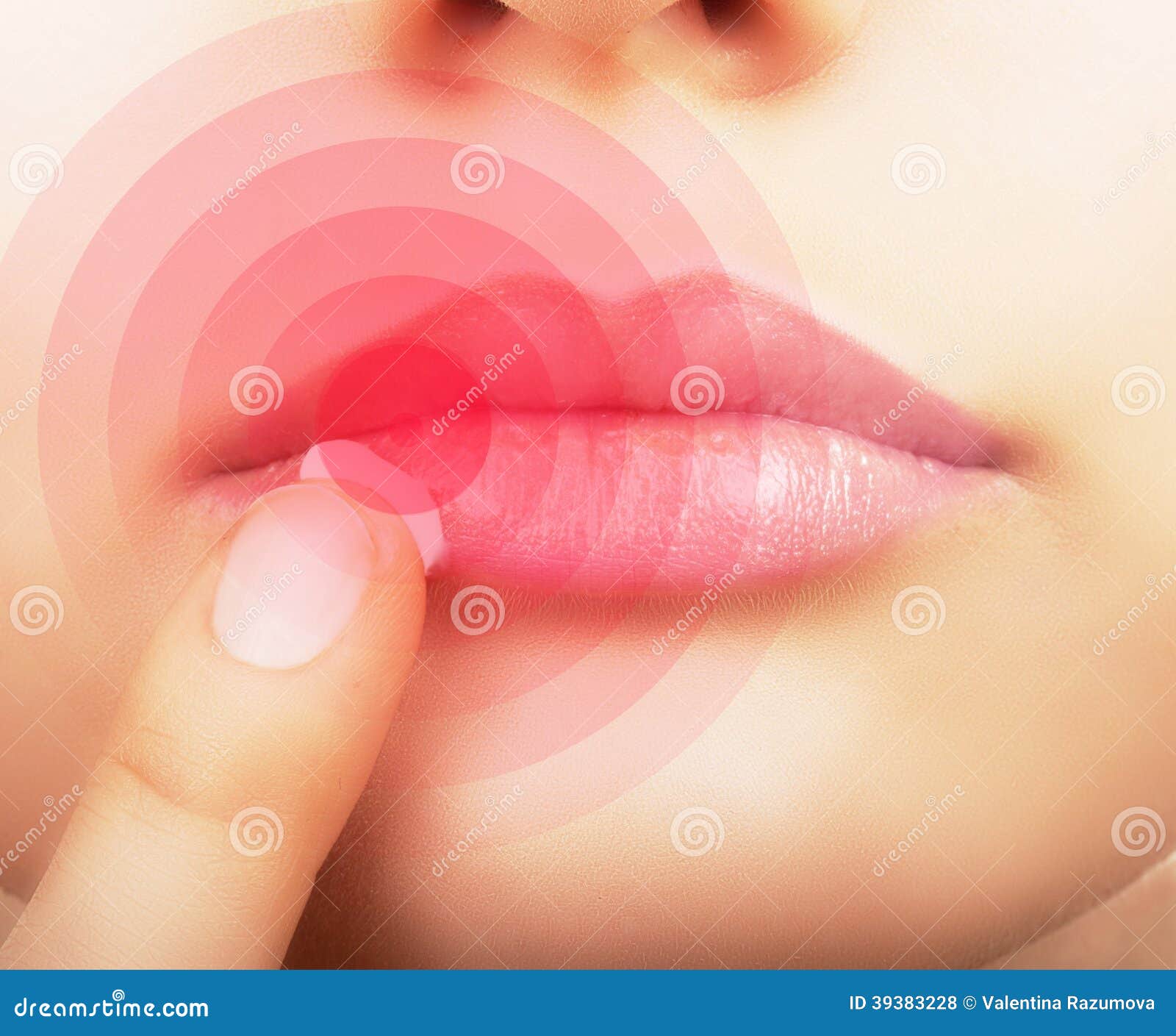 lips affected by herpes.