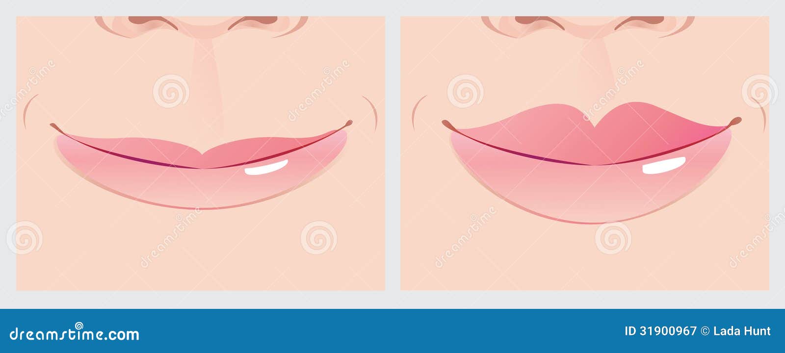 lips correction