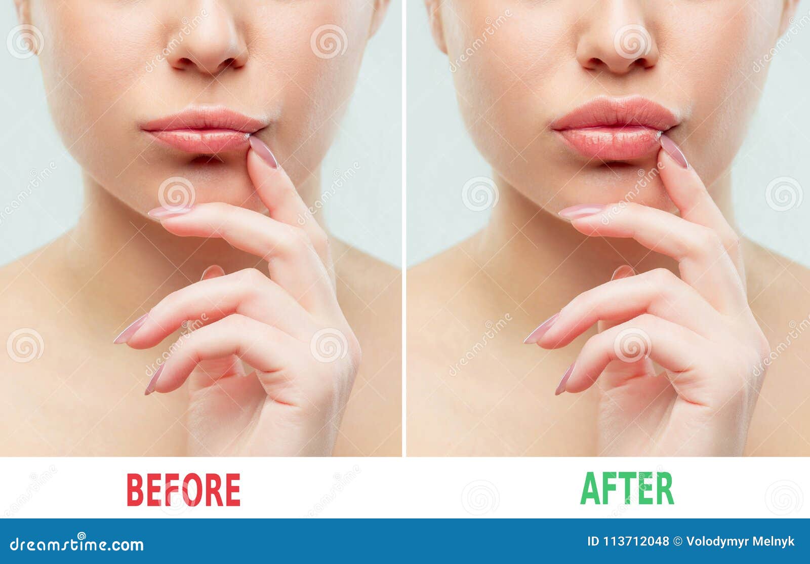 Before after Filler Injections. Beauty Plastic. Beautiful Perfect Lips with Natural Makeup Stock Photo - Image of isolated, beautiful: