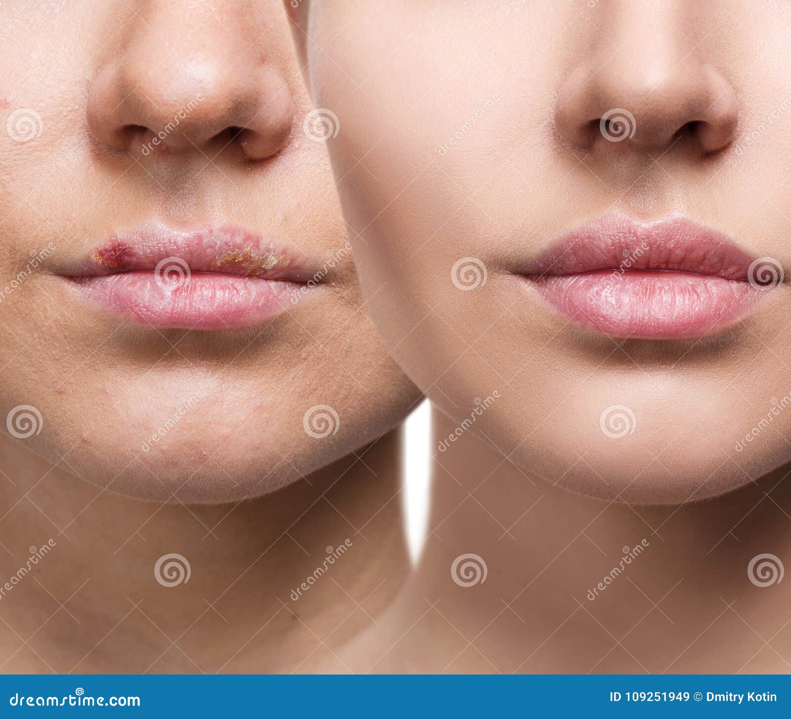 Lips With Herpes Before And After Treatment. Stock Image