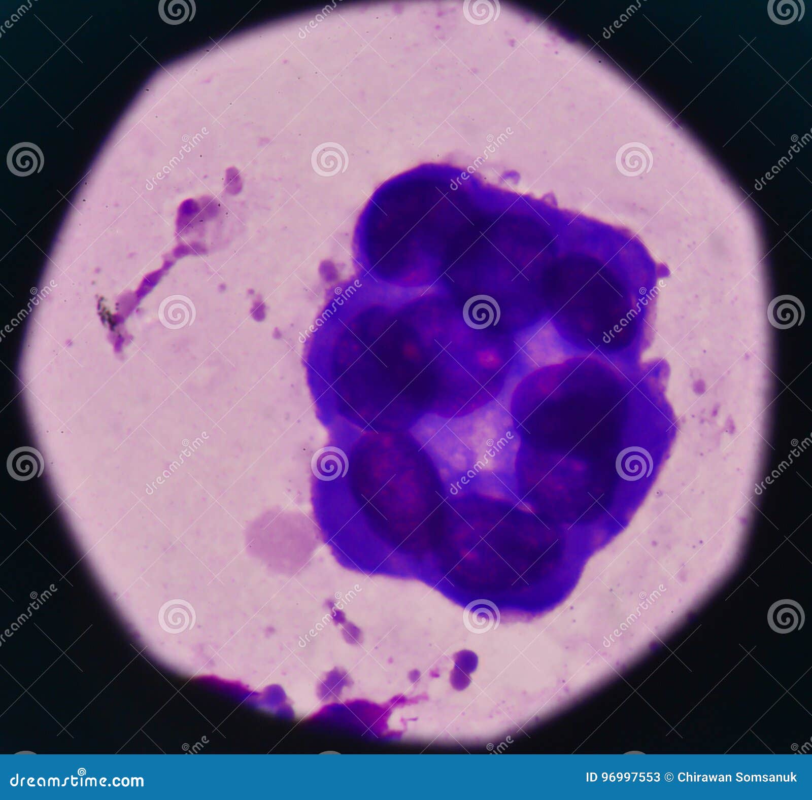 Атипичные клетки в цитологии что это. Мезотелий цитология. Клетки мезотелия. Плазматические клетки в плевральной жидкости. Пролиферация мезотелия.