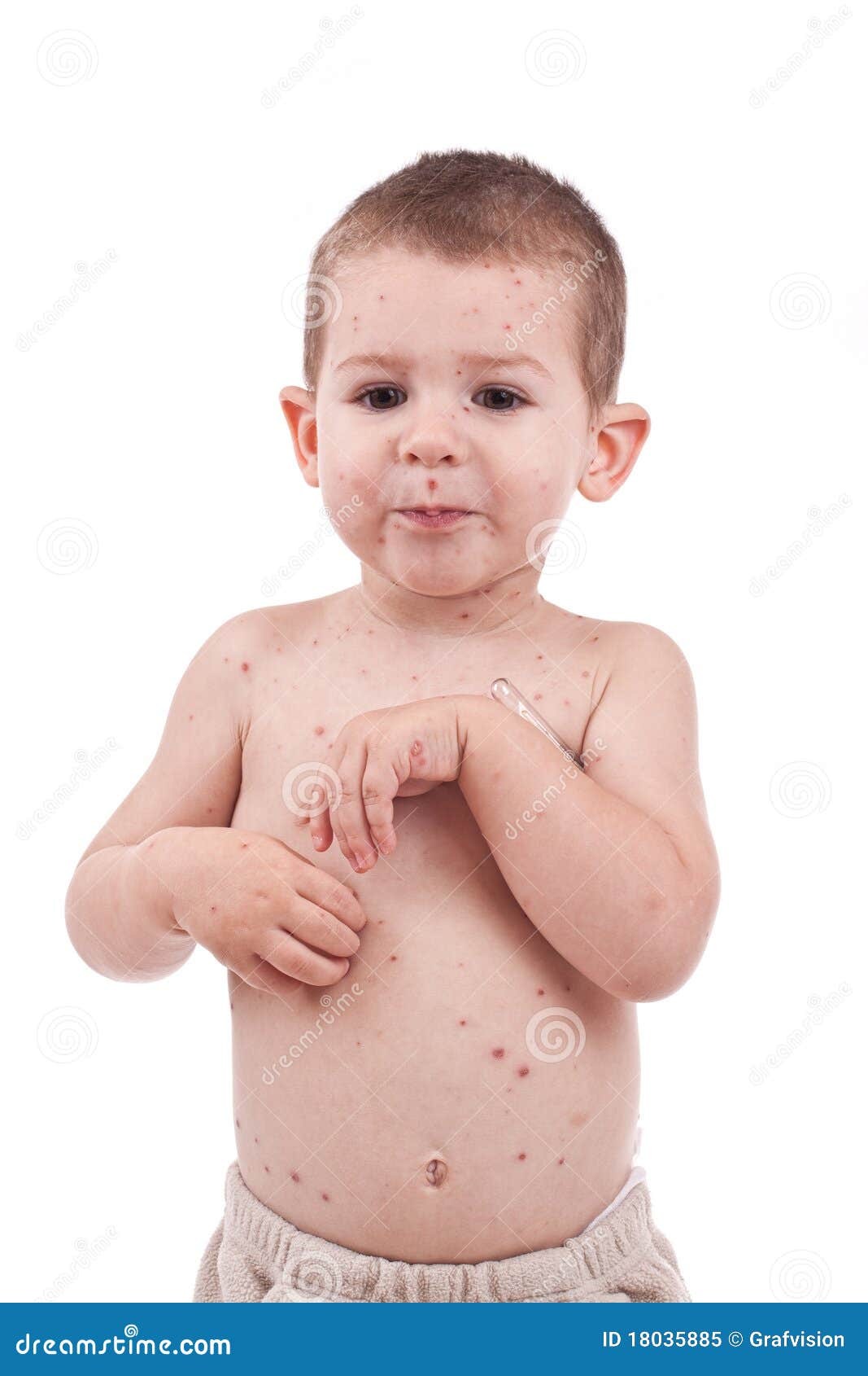 little boy whit smallpox