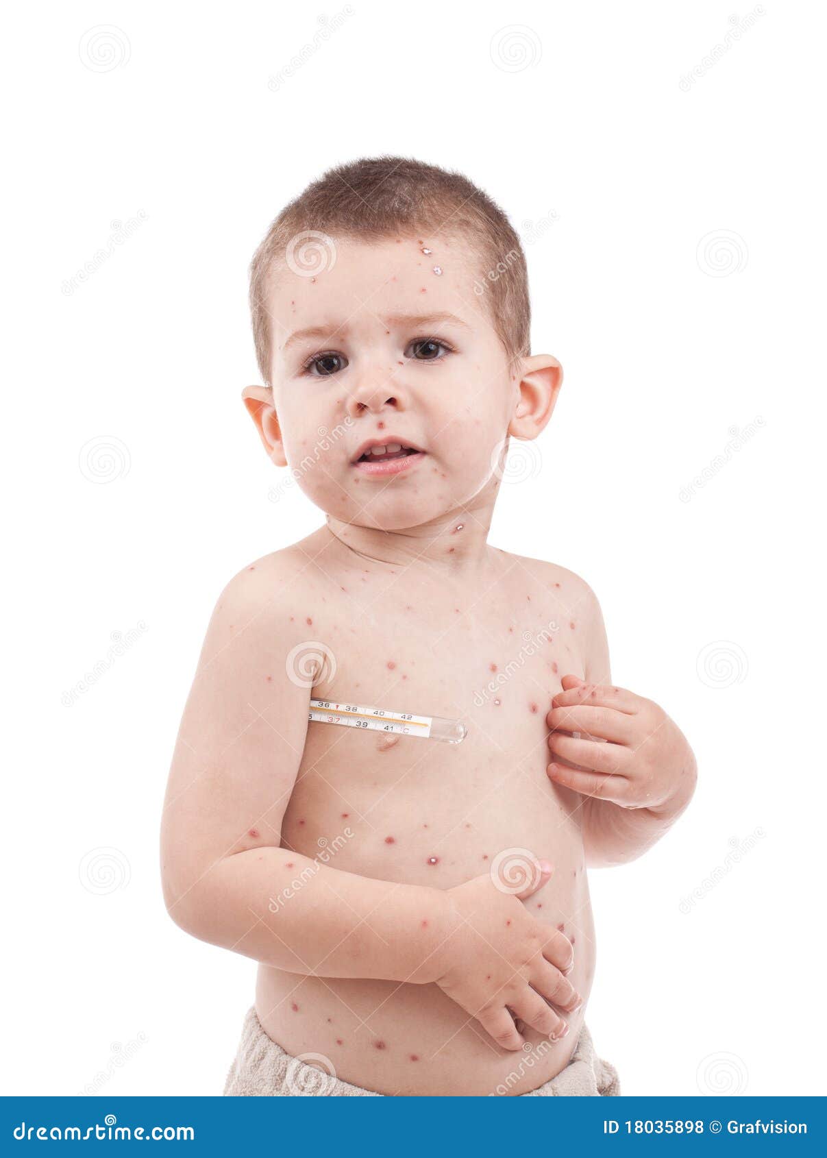 little boy whit smallpox