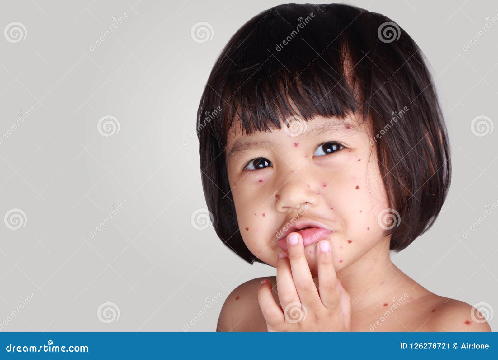 little girl with smallpox