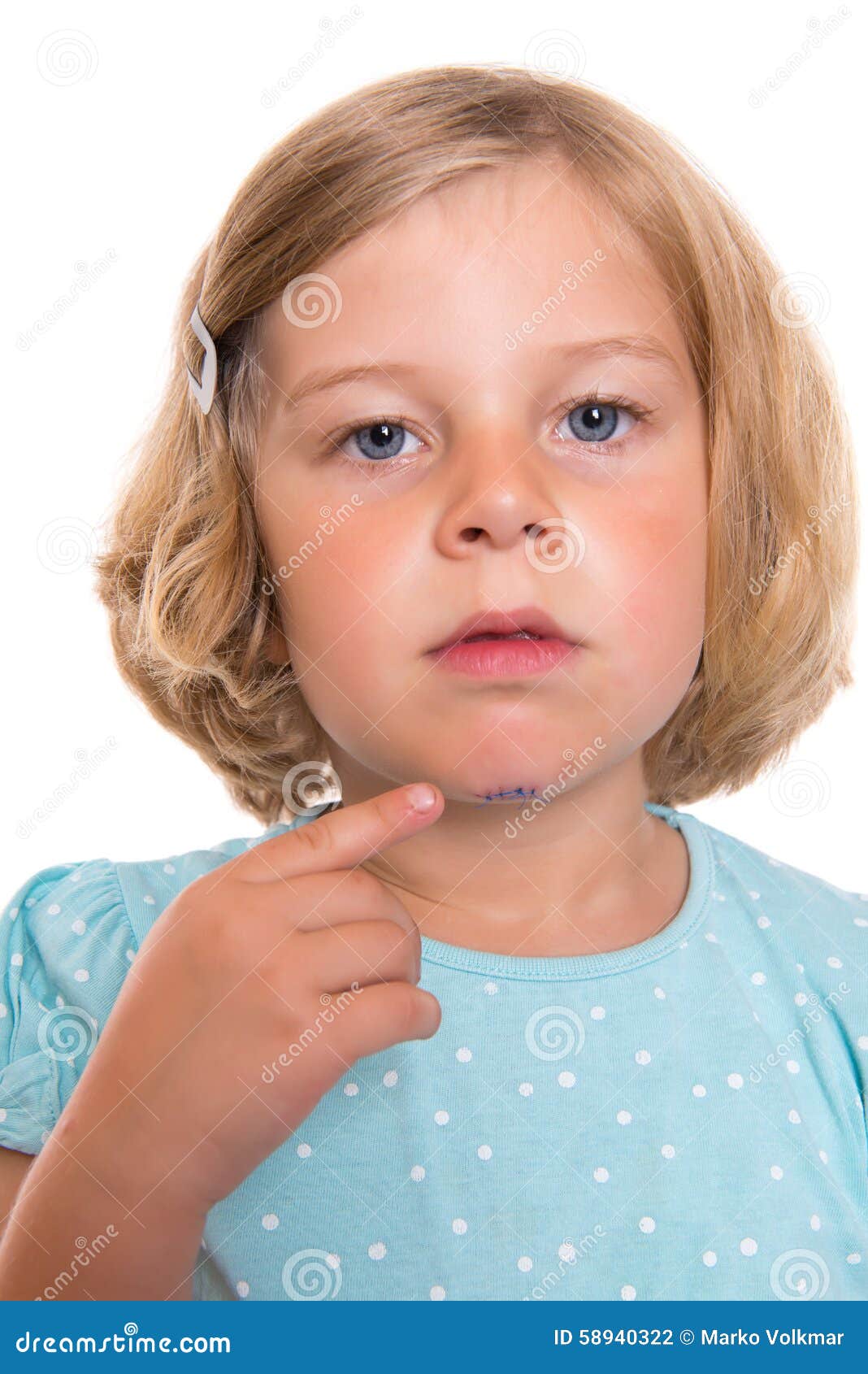 Little White Girl With Wound In Her Face Stock Photo Image Of