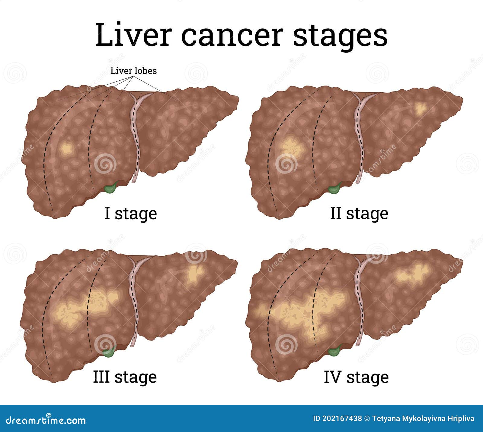 Рак печени 3 стадии