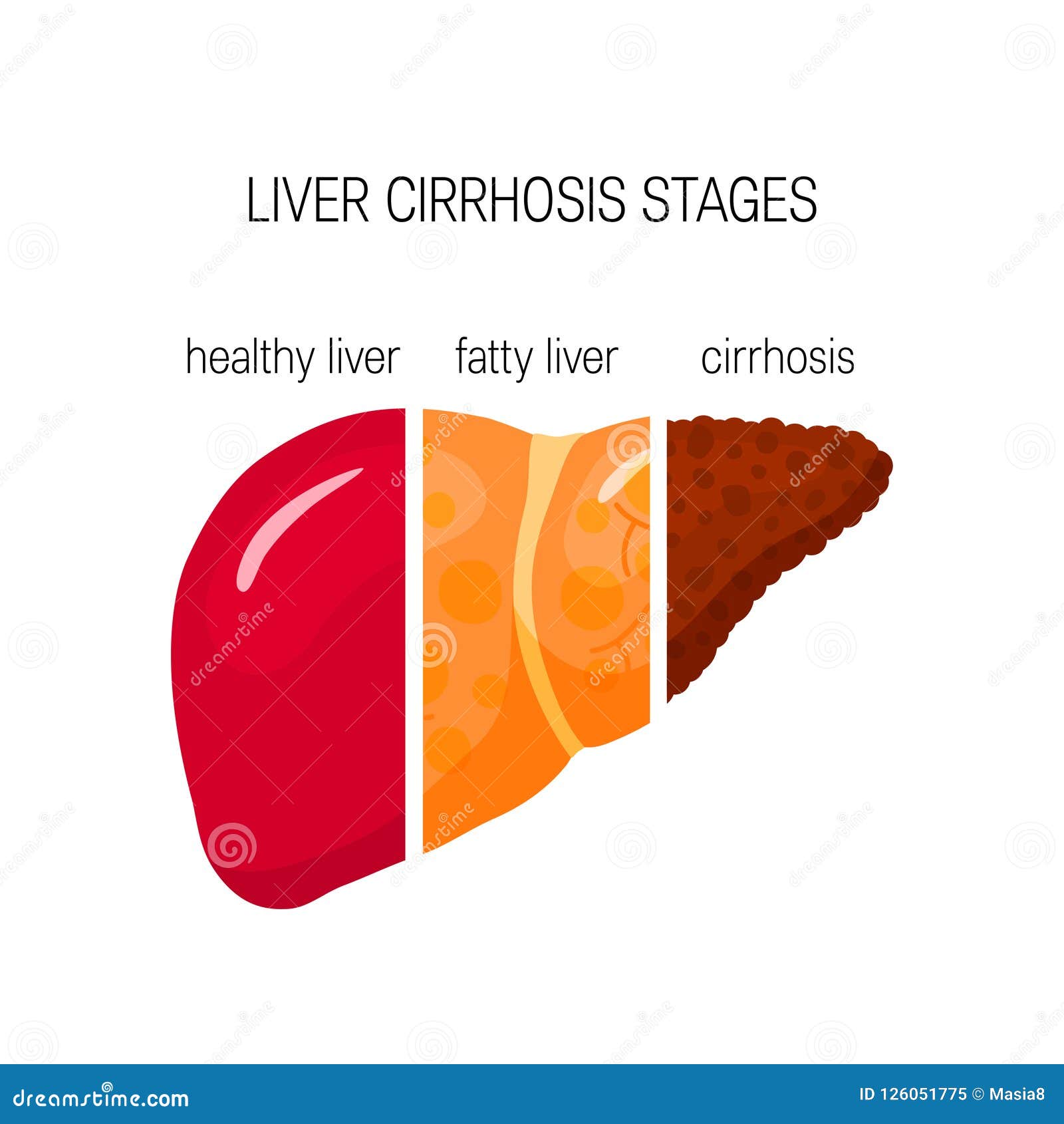liver cirrhosis concept