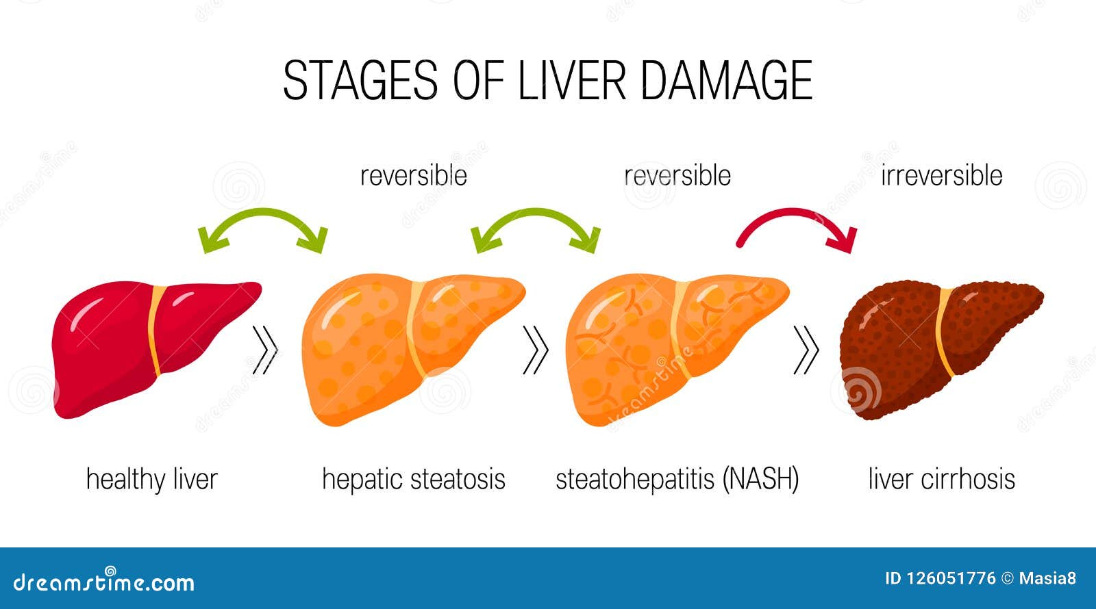 Liver Damage Vector Concept Stock Illustration - Illustration of liver ...