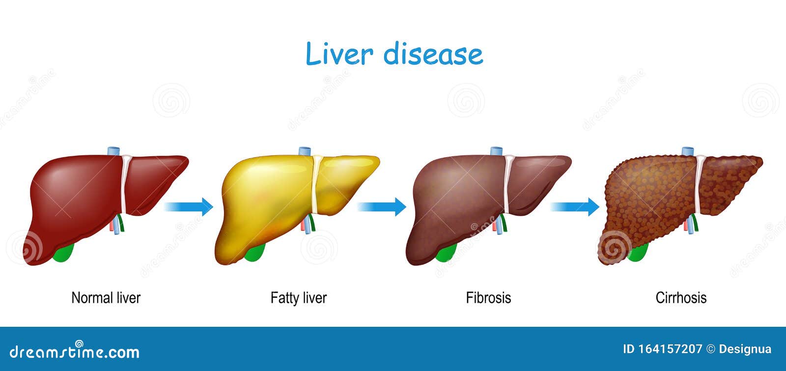 Healthy, Fatty And Cirrhosis Of The Liver Vector Illustration