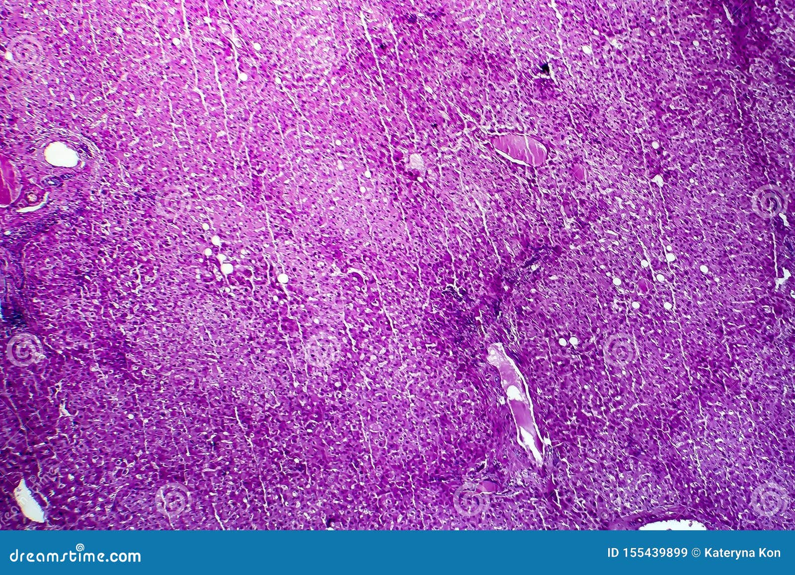 Liver Edema, Light Micrograph Stock Image Image of medicine