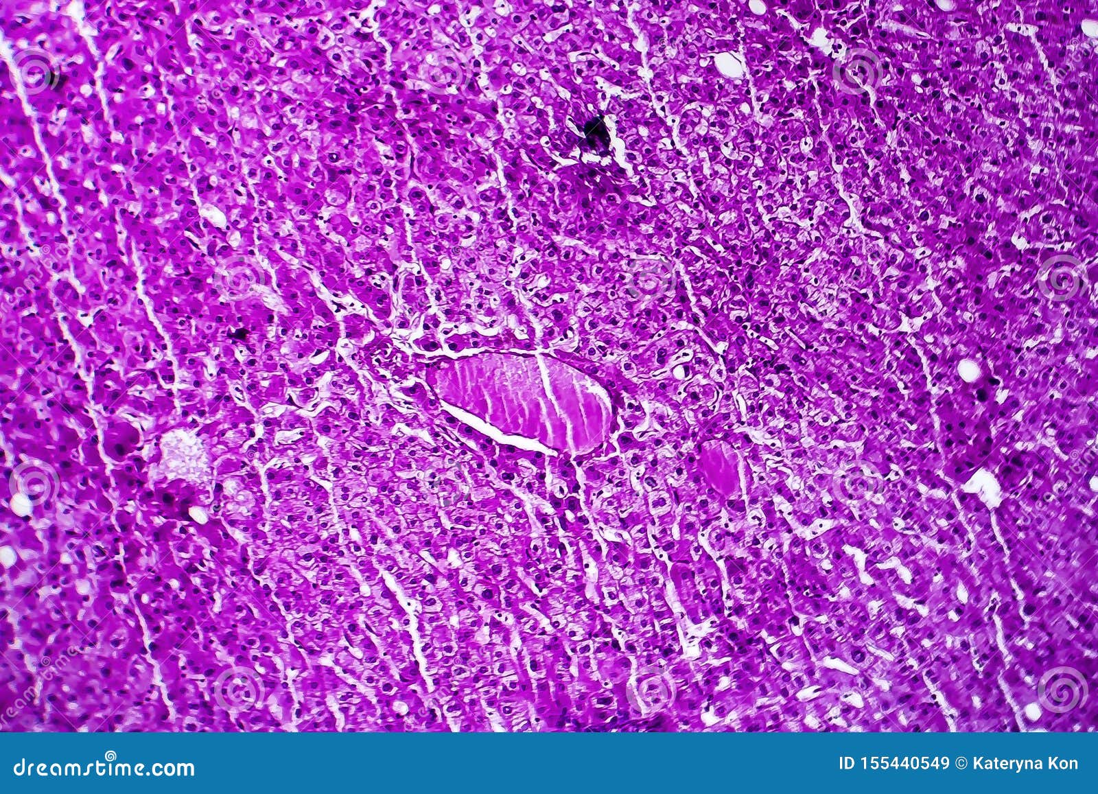 Liver Edema, Light Micrograph Stock Photography