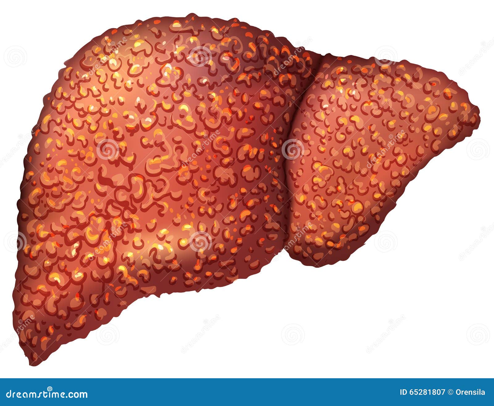 liver patients with hepatitis. liver is sick person. cirrhosis of liver. repercussion alcoholism