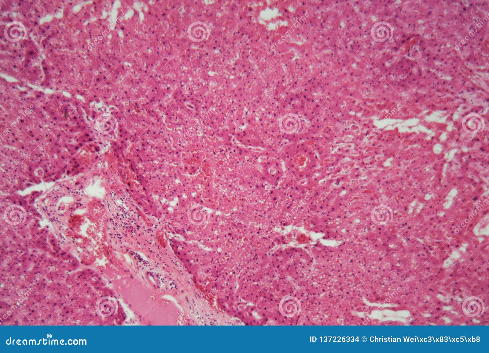 Liver Tissue With Amyloidosis Under A Microscope RoyaltyFree Stock