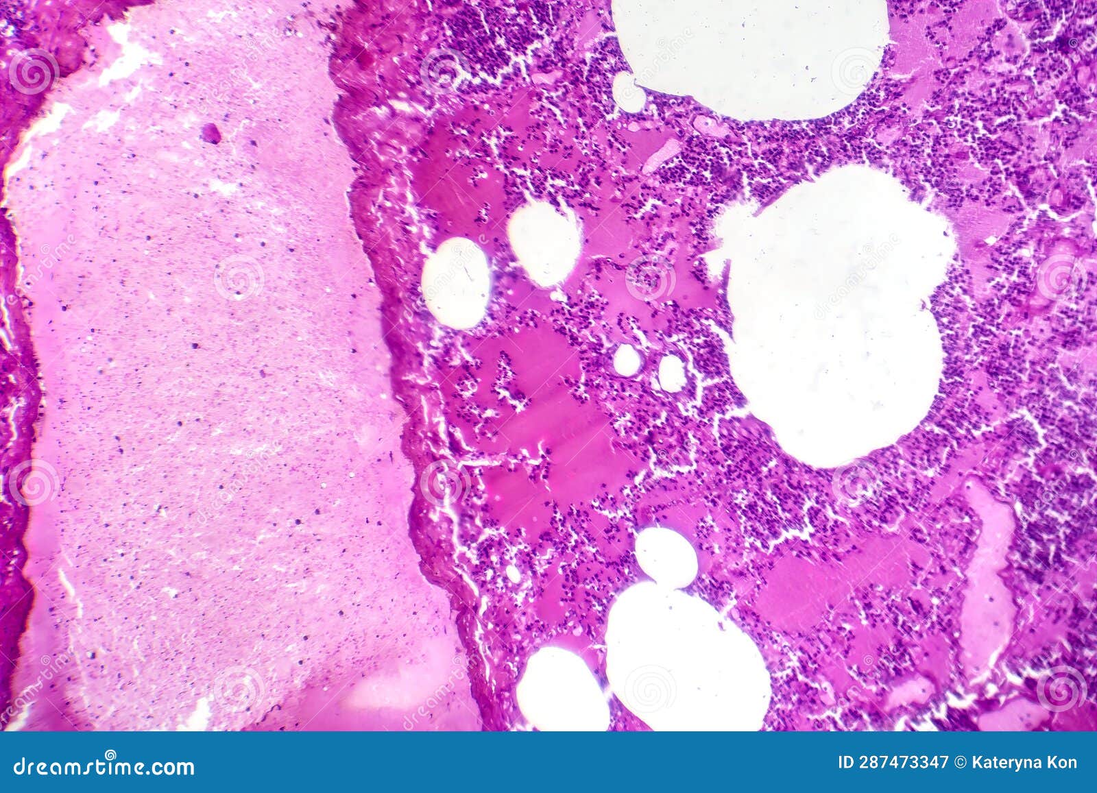 Lobar Pneumonia During The Hemorrhagic Edema Period, Light Micrograph