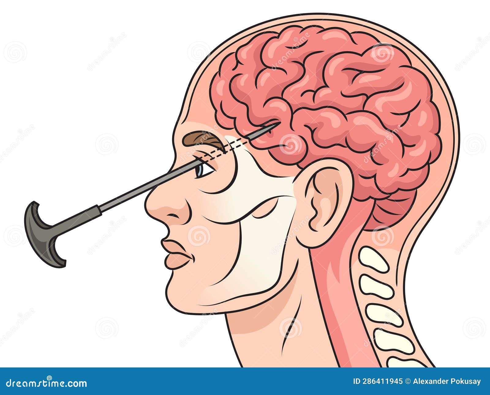 lobotomydiagrammedicalsciencelobotomyleucotomyneurosurgical