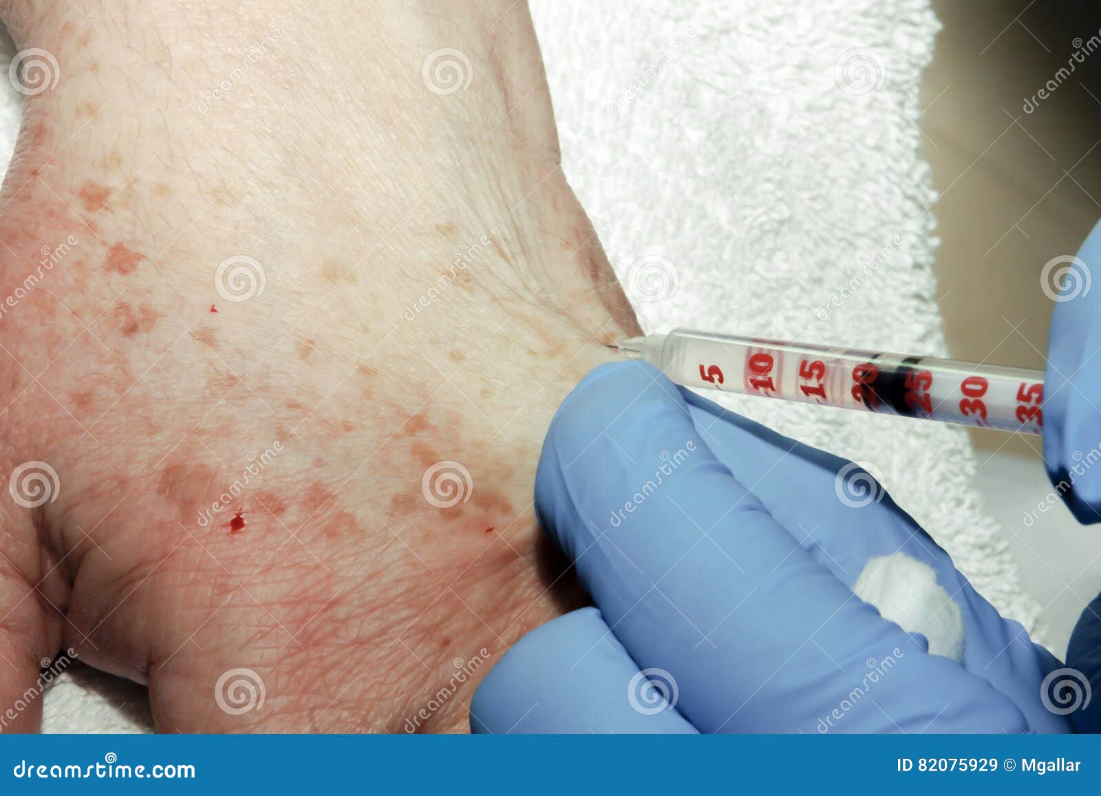 Local Anesthesia on the Hand Stock Image Image of nurse, mouth 82075929