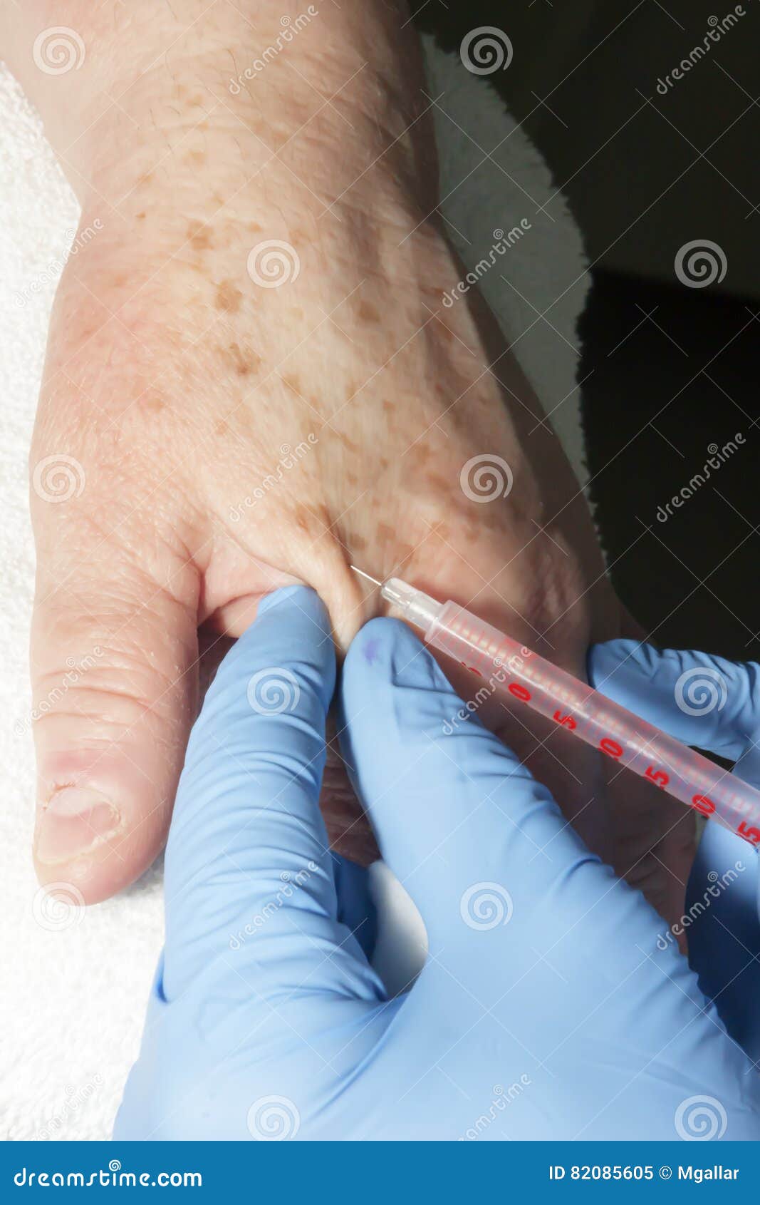 Local Anesthesia on the Hand Stock Image Image of close, micro 82085605