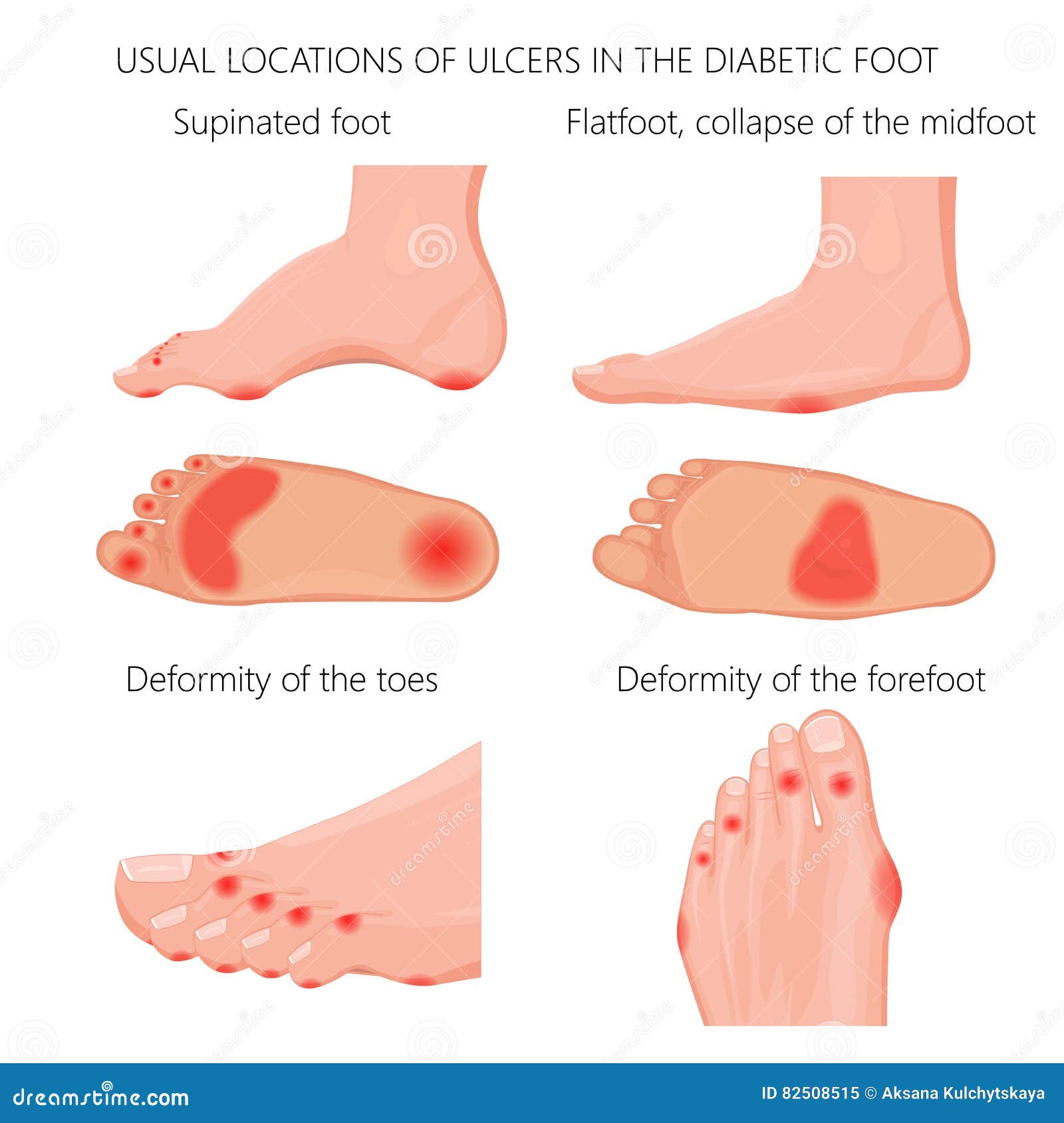 location of the diabetic foot ulcers