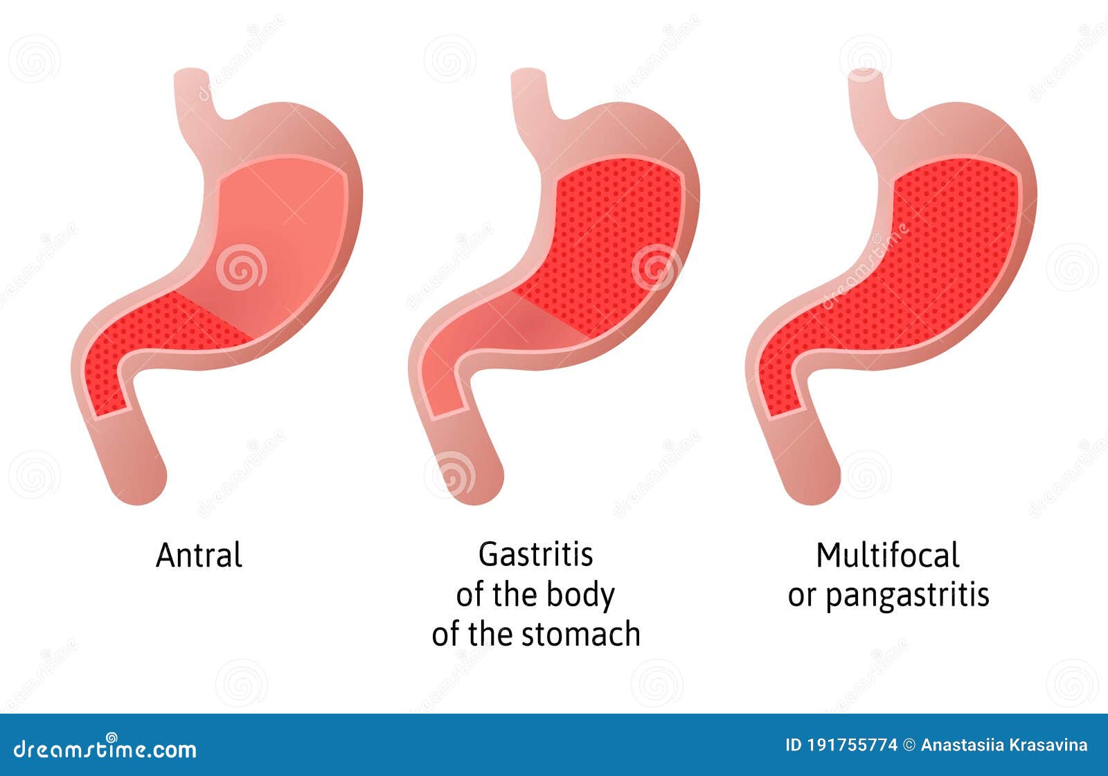 Gastritis cronica antral Gastritis cronica antral