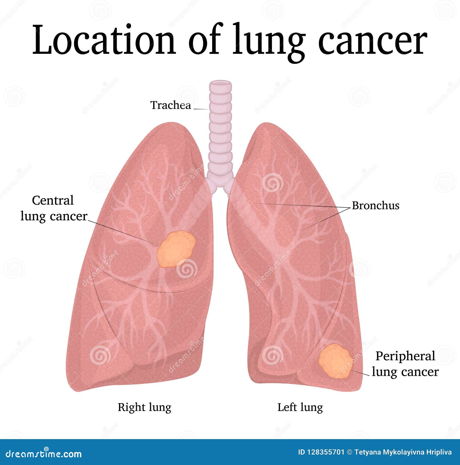 Types Of Lung Cancer Tumors