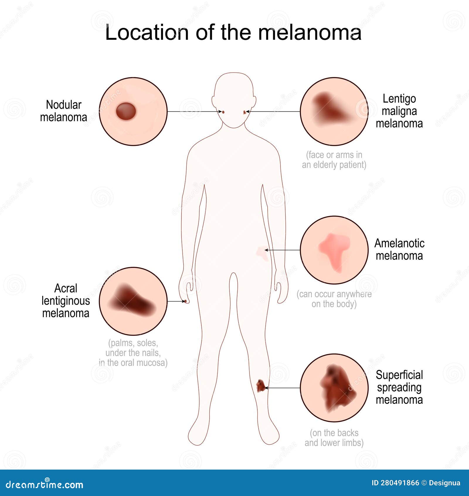 location of the melanoma. close-up of malignant skin cancer