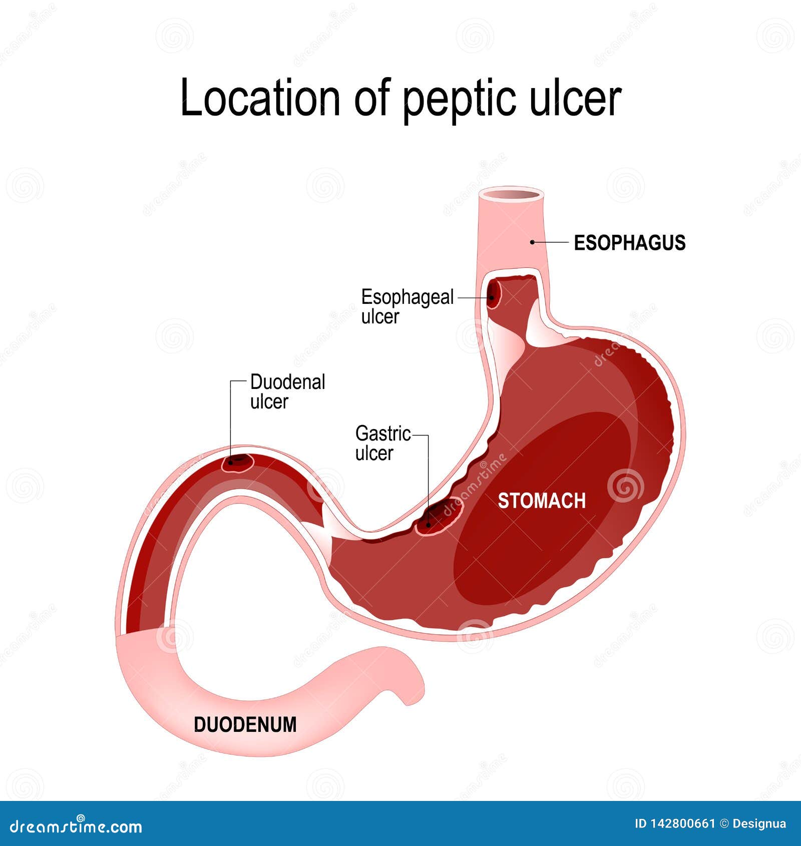 Peptic Ulcer Types