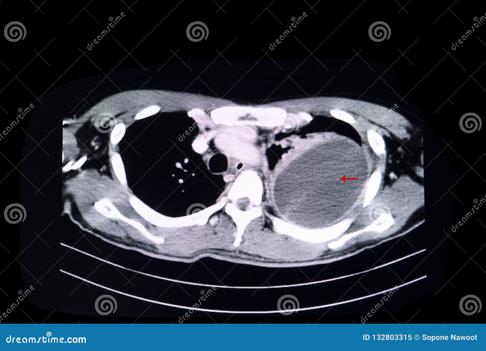 Loculated pleural effusion stock image. Image of computer ...