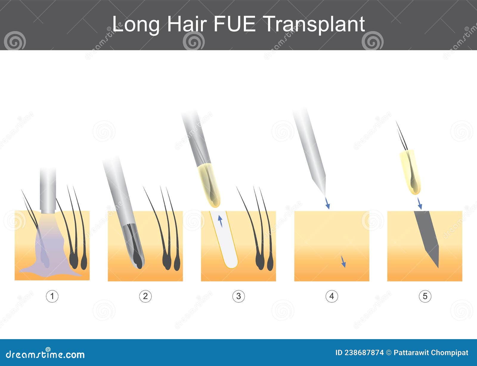 long hair fue transplant.