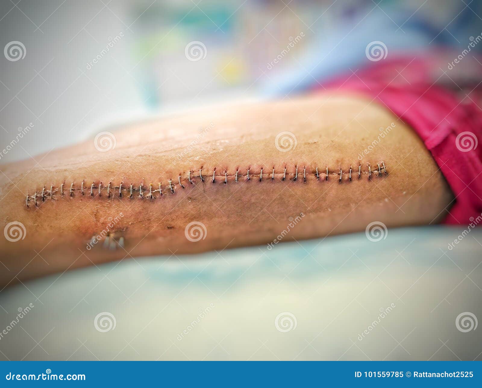 Long scar on leg stock image. Image of long, scar, staples 101559785