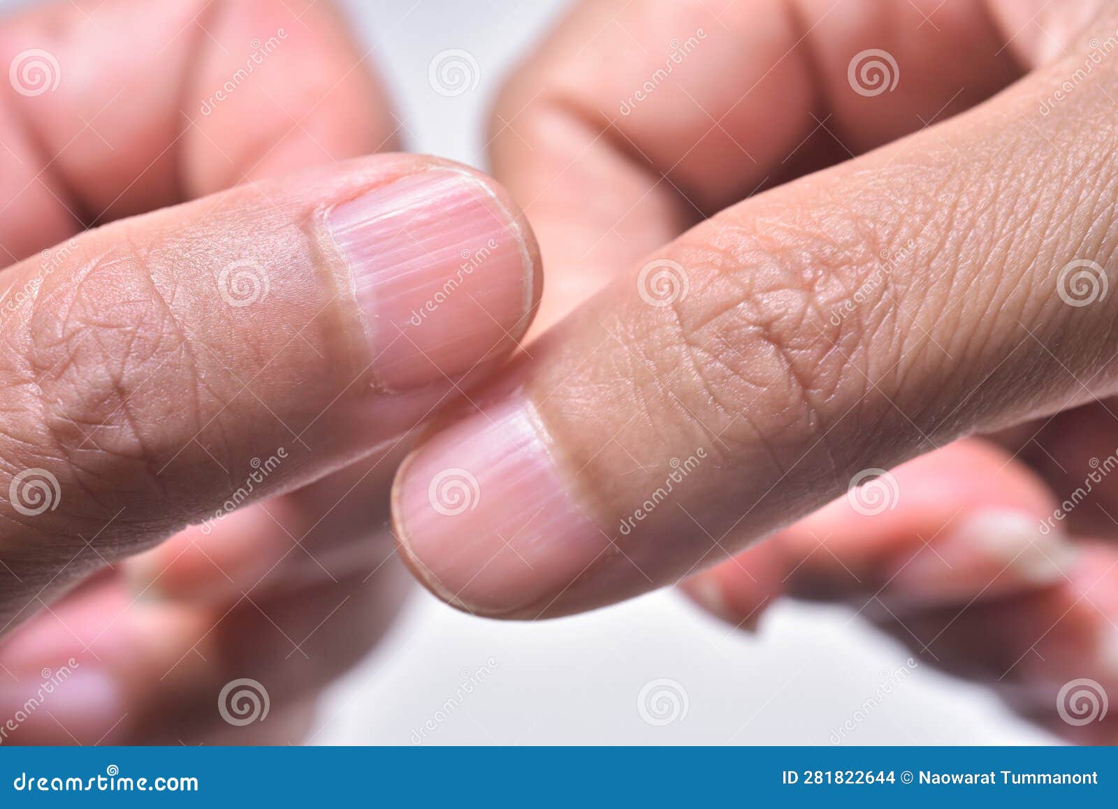 longitudinal ridging nail fingernail vertical nail ridges longitudinal ridging nail vertical nail ridges common causes 281822644