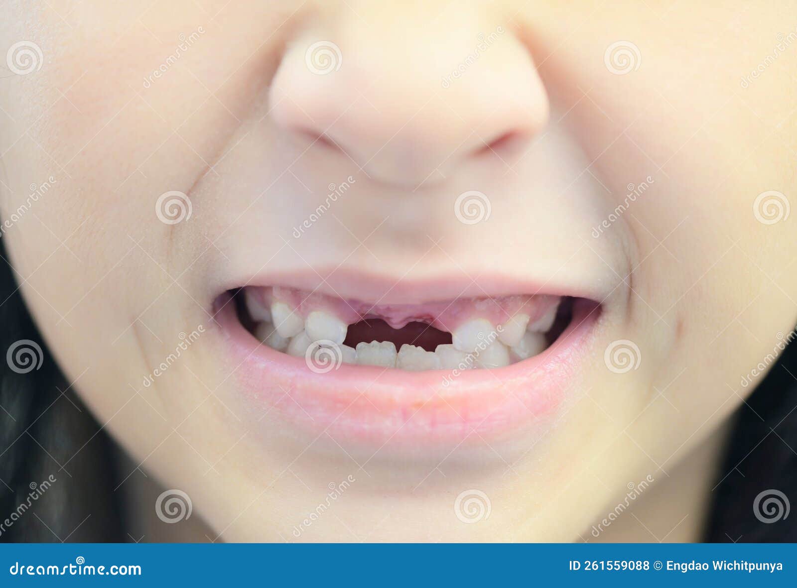 Lost Milk Teeth - Lost Baby Tooth , Smile Face of a Child Girl Baby