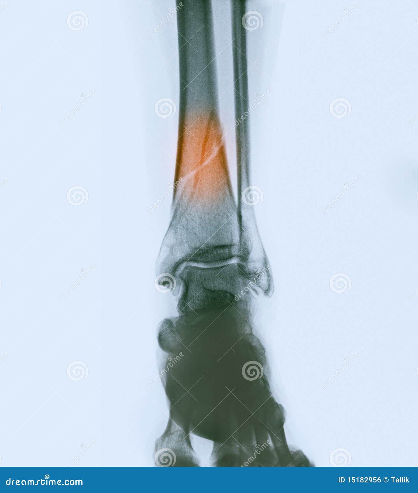 Lower Leg Xray Showing a Fracture Stock Photo Image of human