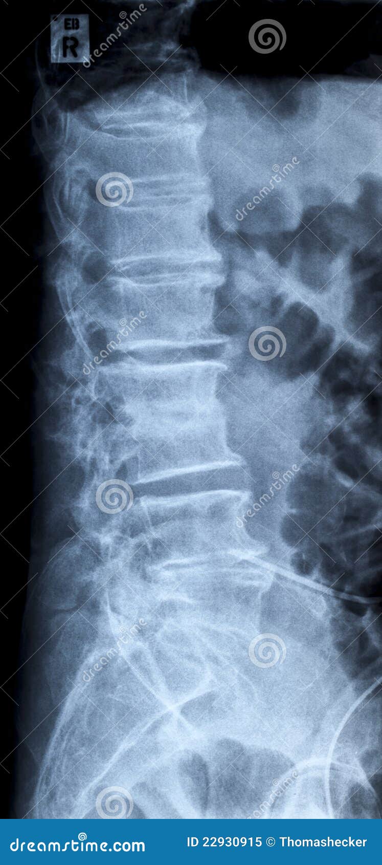 lumbar disc herniation