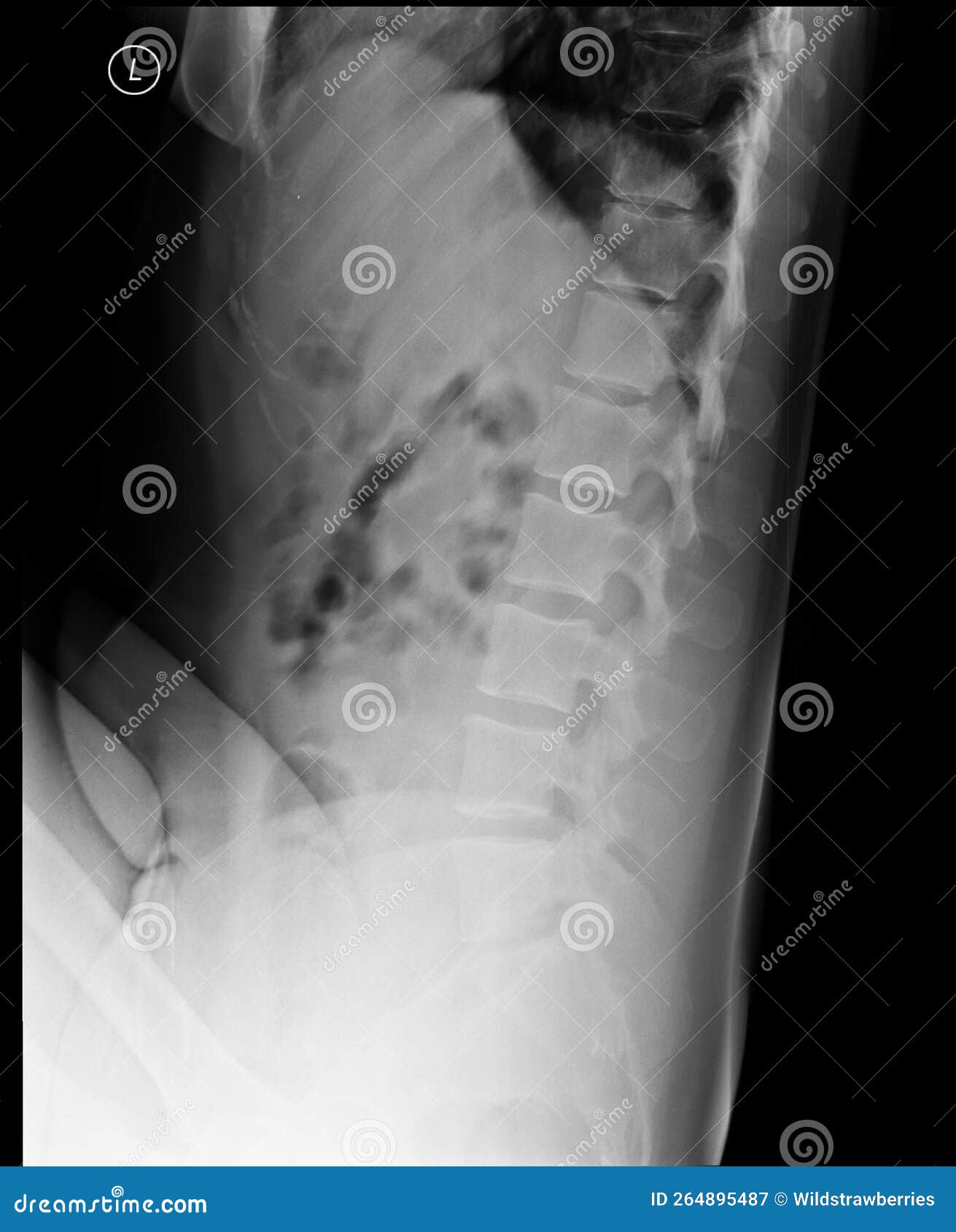lumbosacral spine x-ray. lateral view.