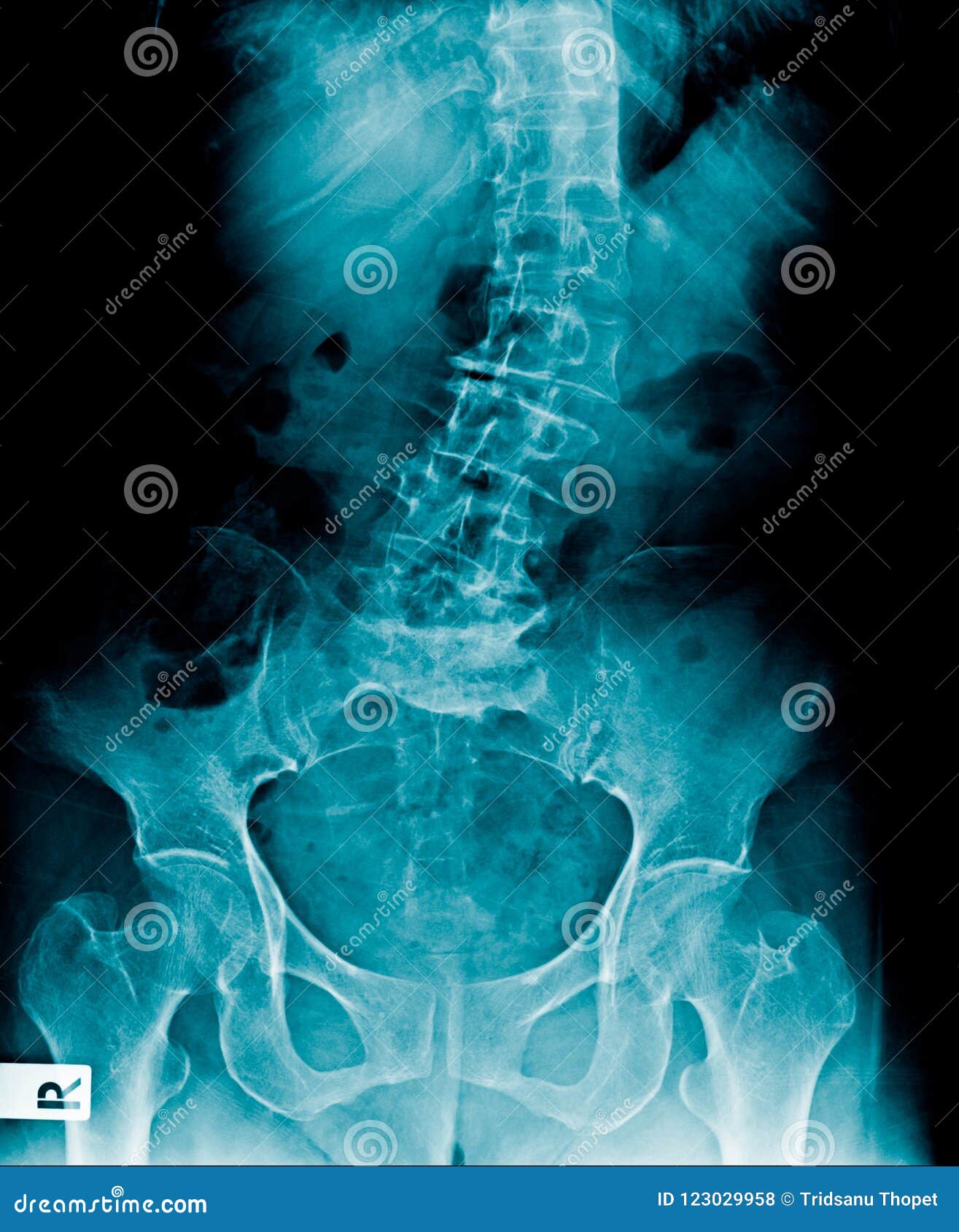 scoliosis lumbar x-ray image