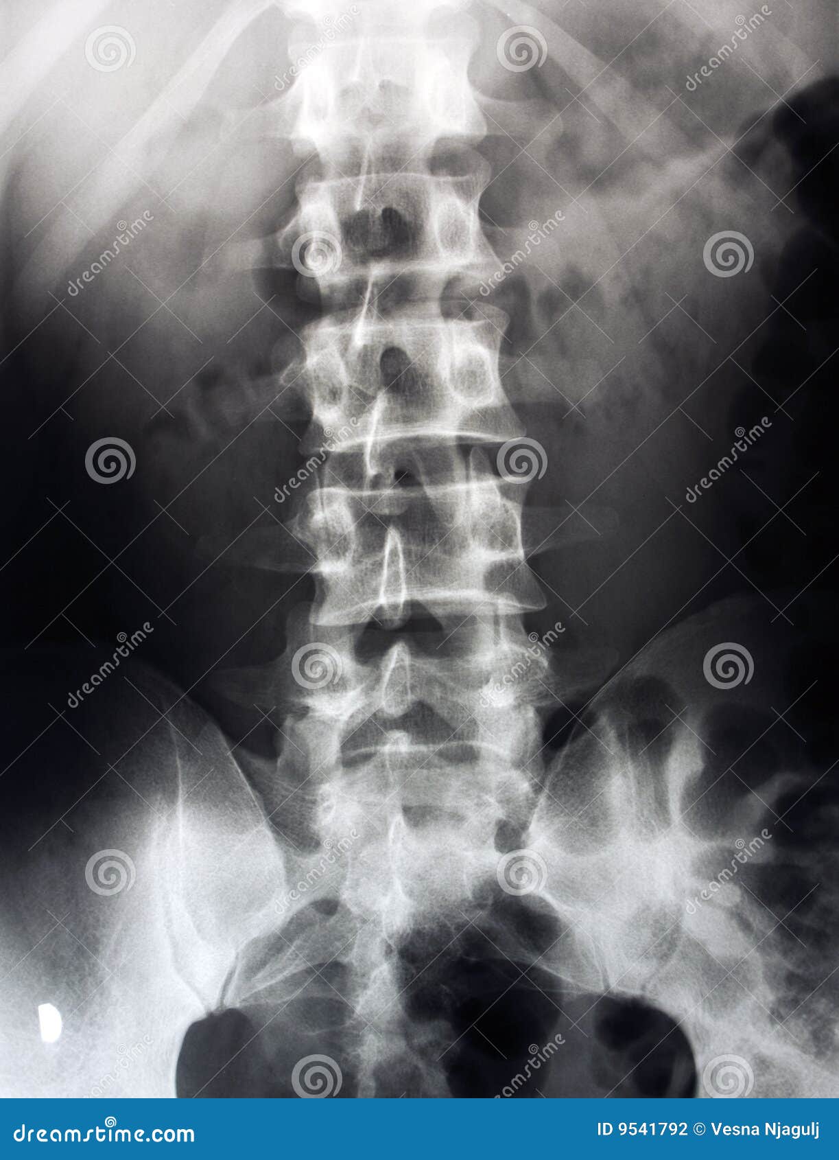 lumbar spine x-ray, lower back