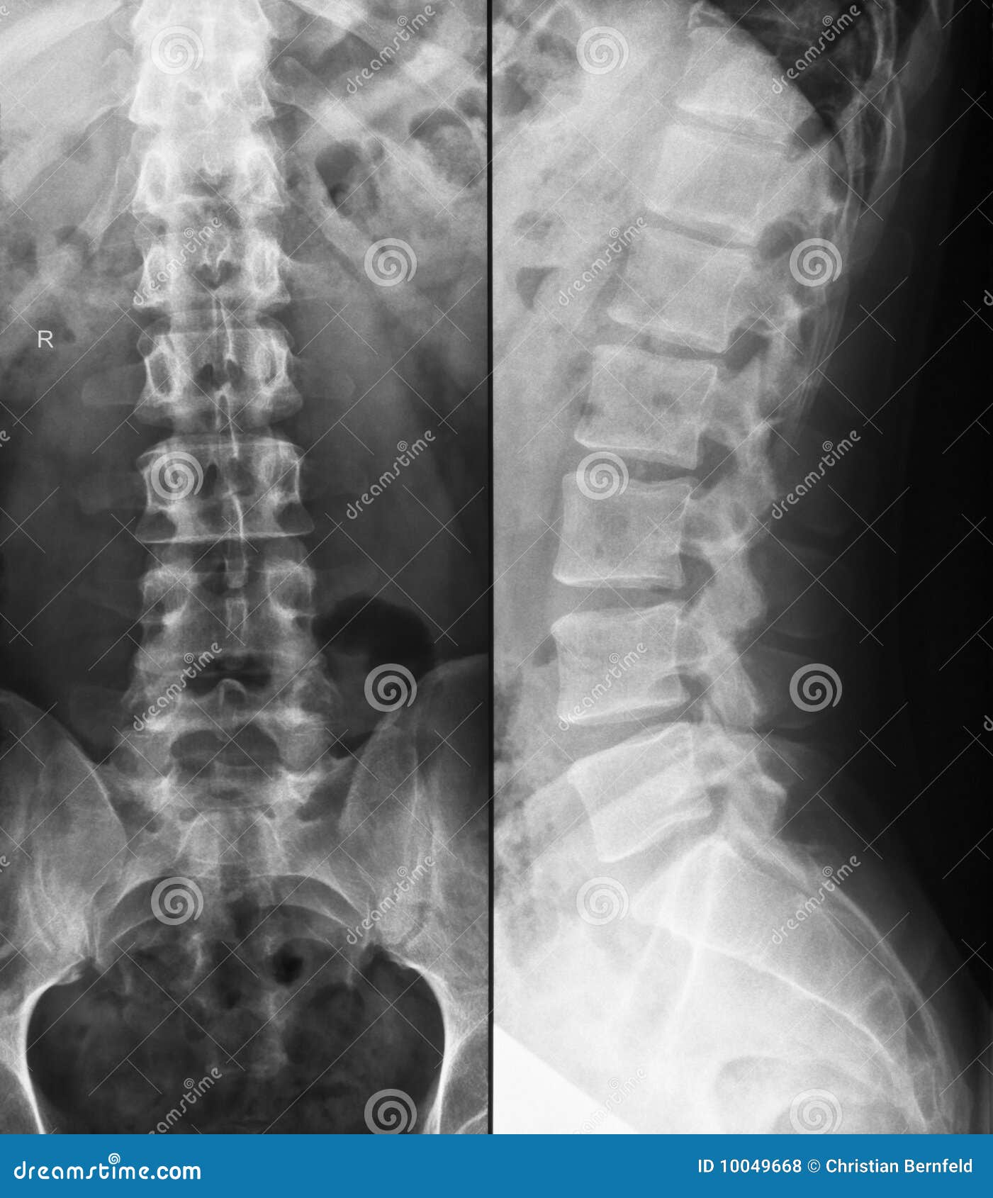 Lumbar Spine X-Ray With Slight S-shaped Skoliosis Royalty Free Stock