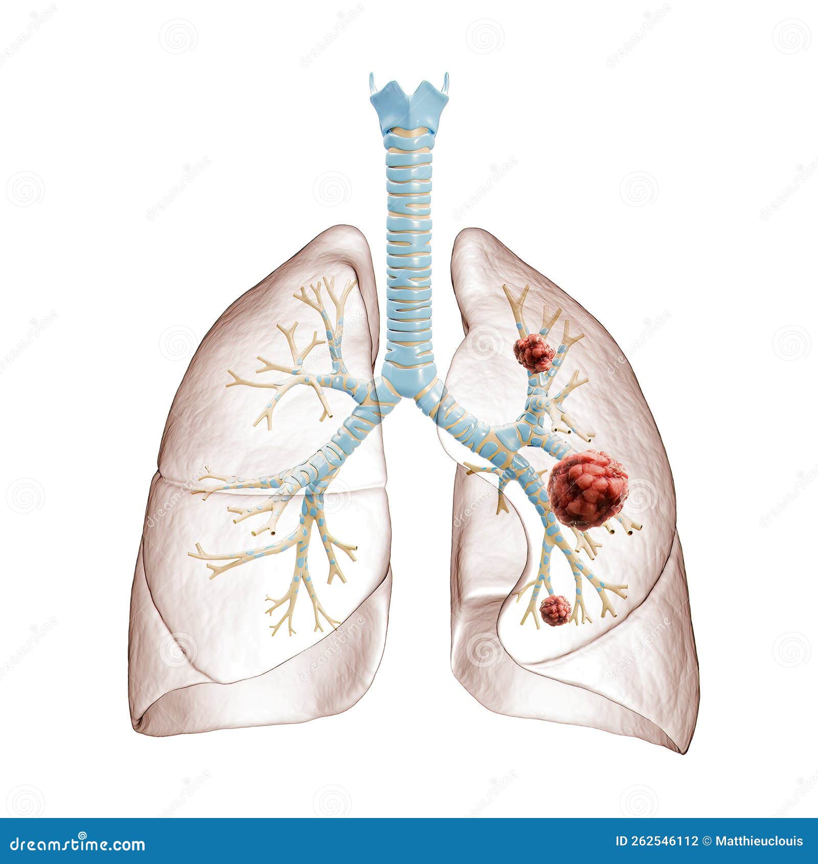 Lung Cancer Or Carcinoma 3d Rendering Illustration Bronchial Tree And