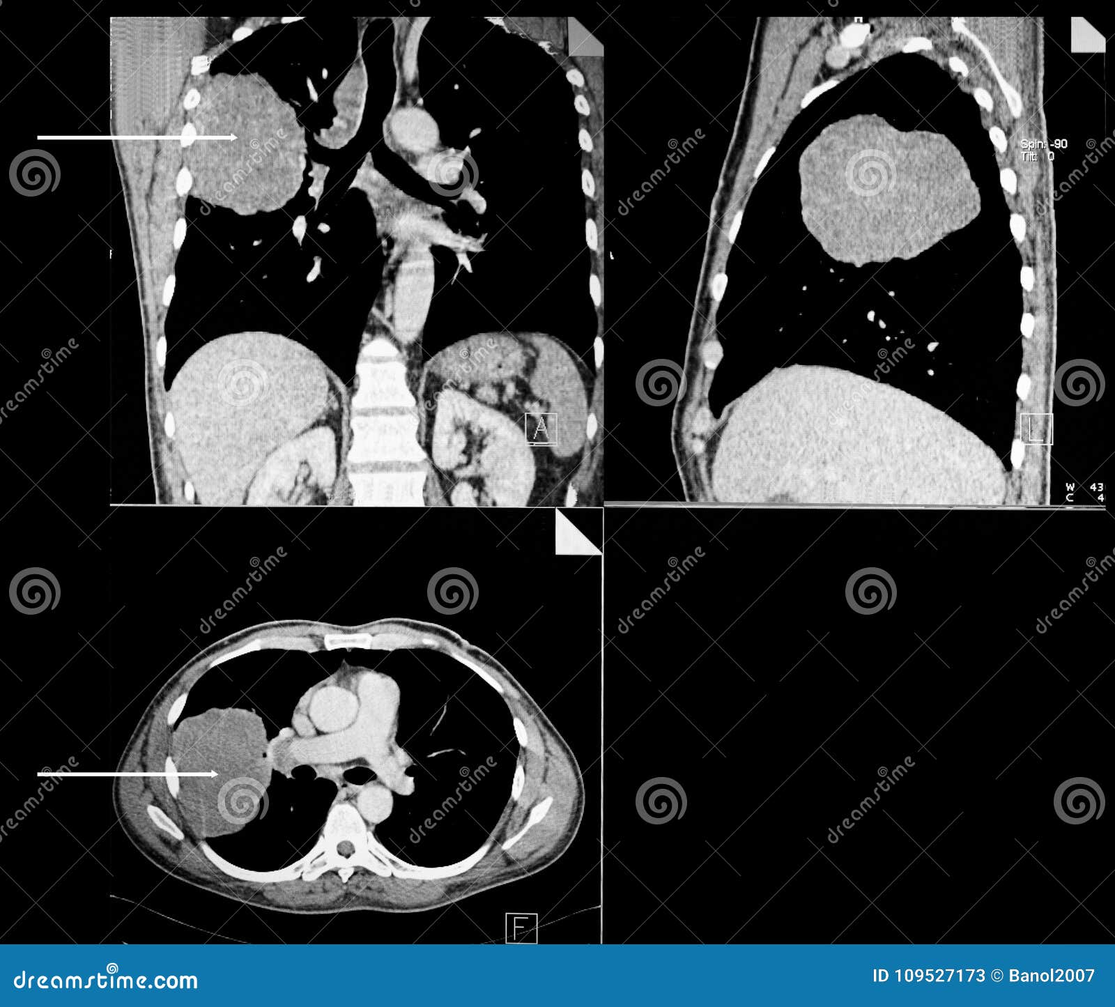 lung cancer. computer tomography reconstruction.