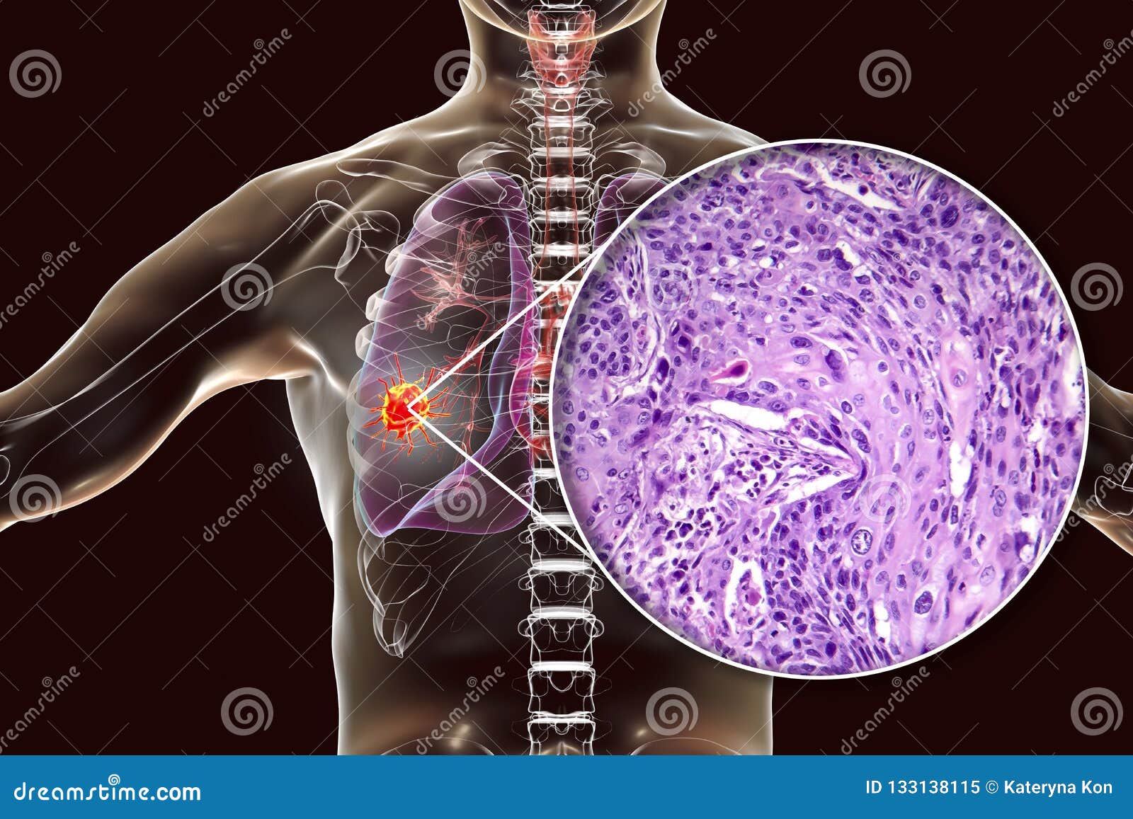 lung cancer cells diagram