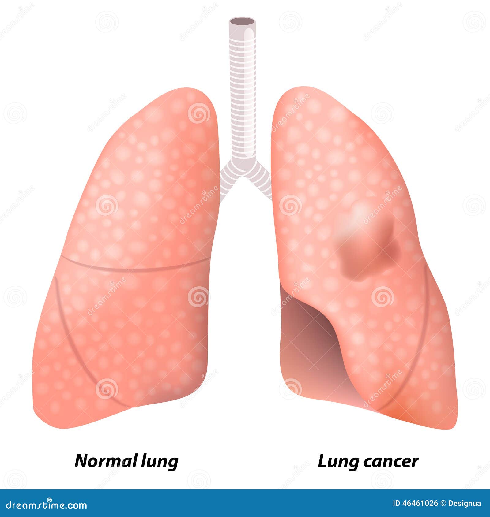 Lung cancer stock vector. Illustration of bronchi, healthy - 46461026