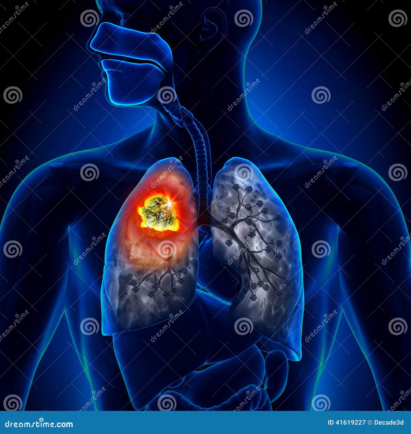 lung cancer - tumor