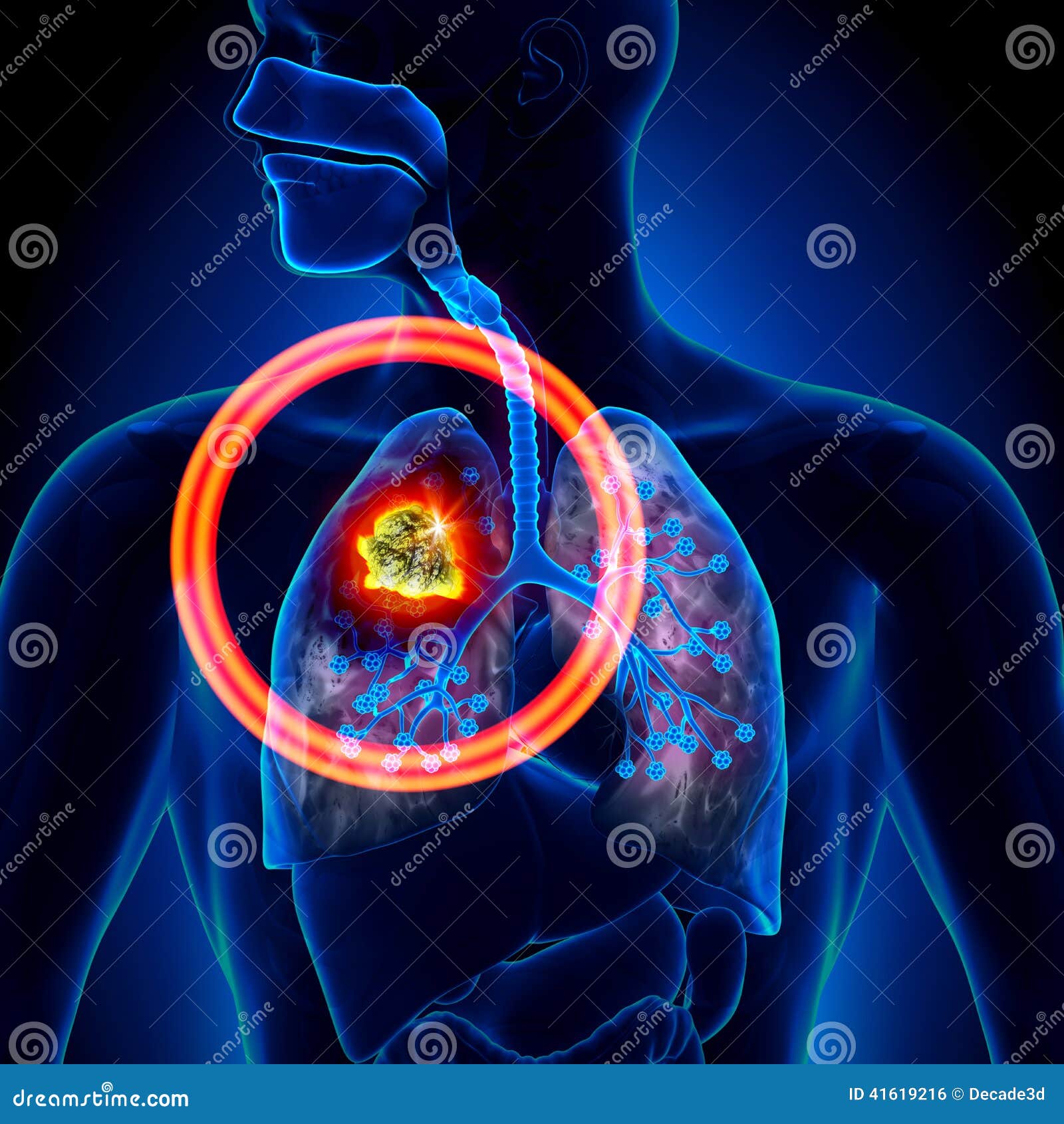 lung cancer - tumor