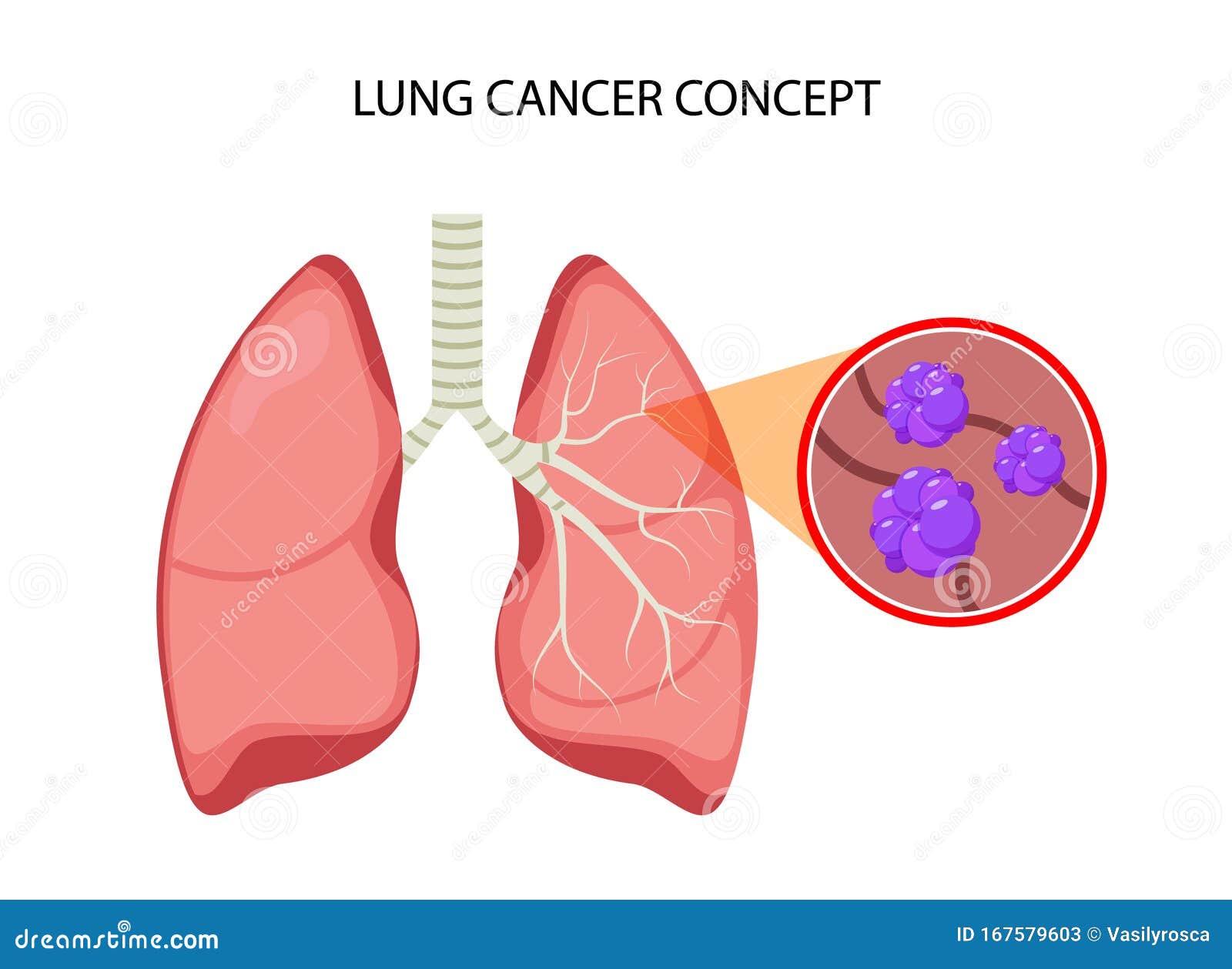 Lung Cancer Vector Concept Repiratory Disease. Cartoon Human Lung ...