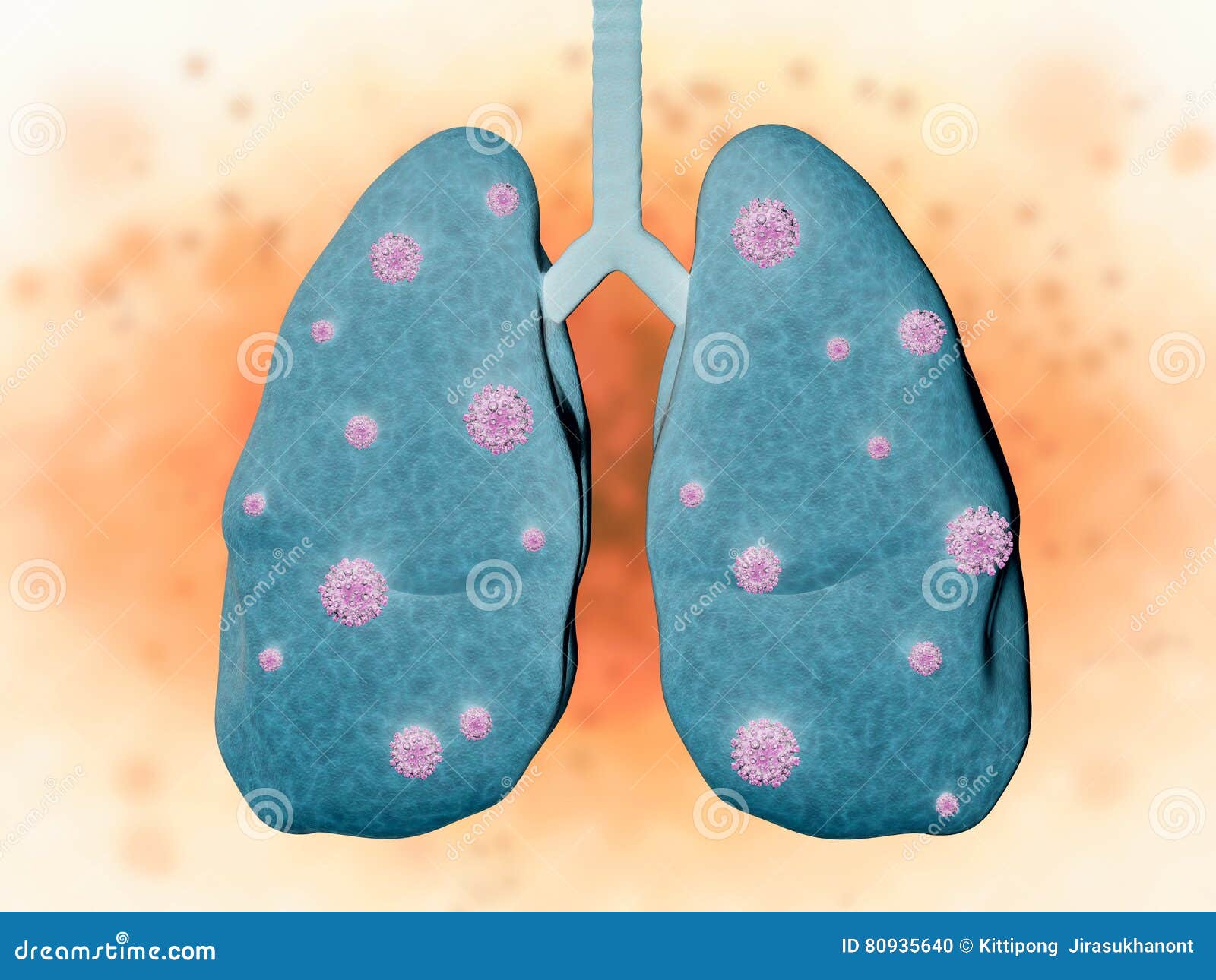 Lung Disease with Bacteria Cells Stock Photo Image of disease 80935640