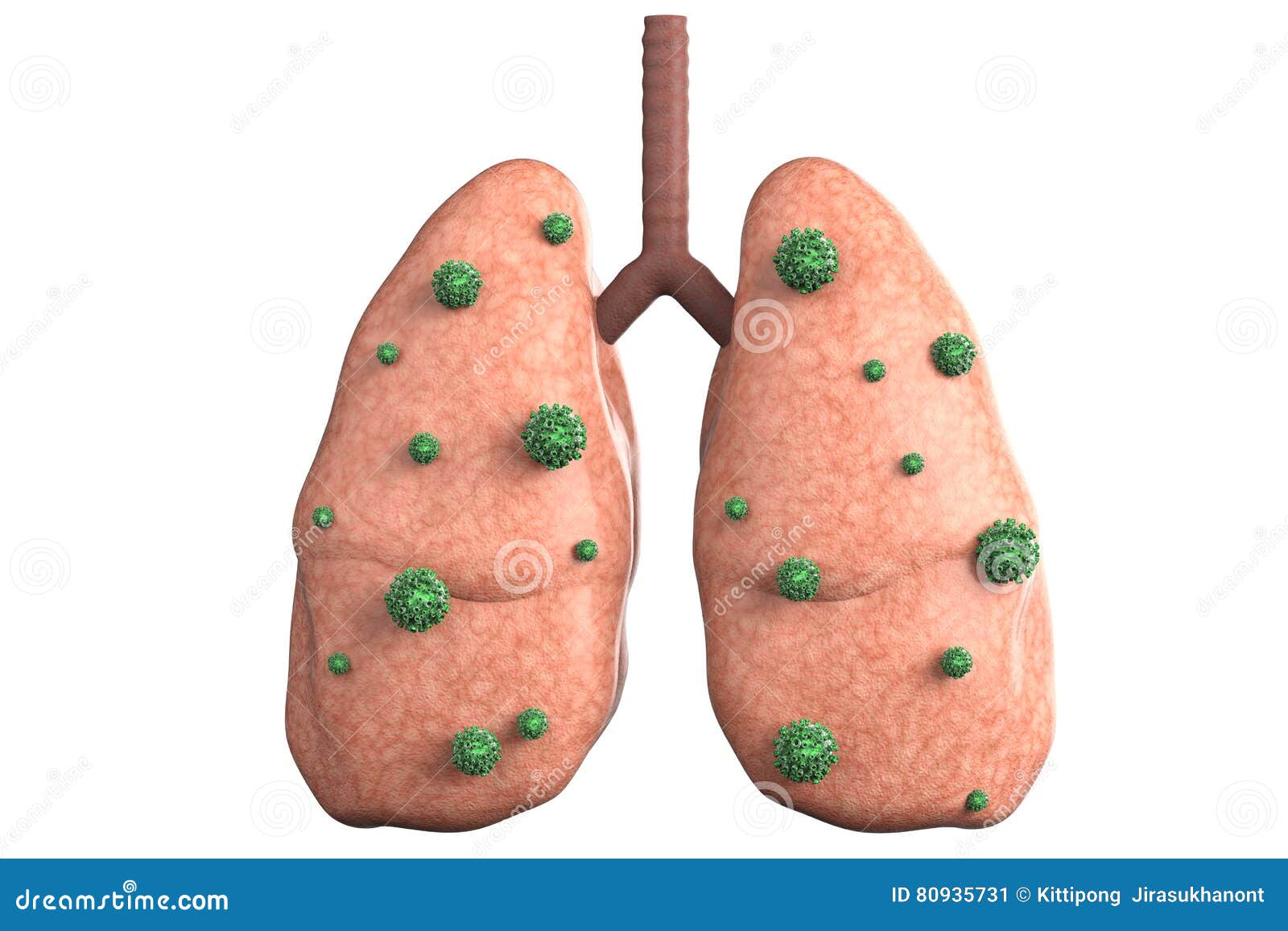 Lung Disease with Bacteria Cells Stock Image Image of lobe, micro 80935731