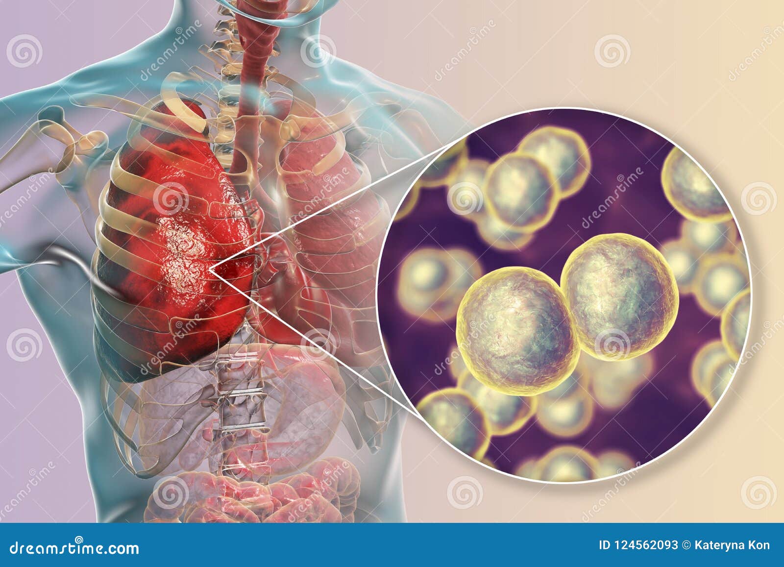 bacterial lung infection