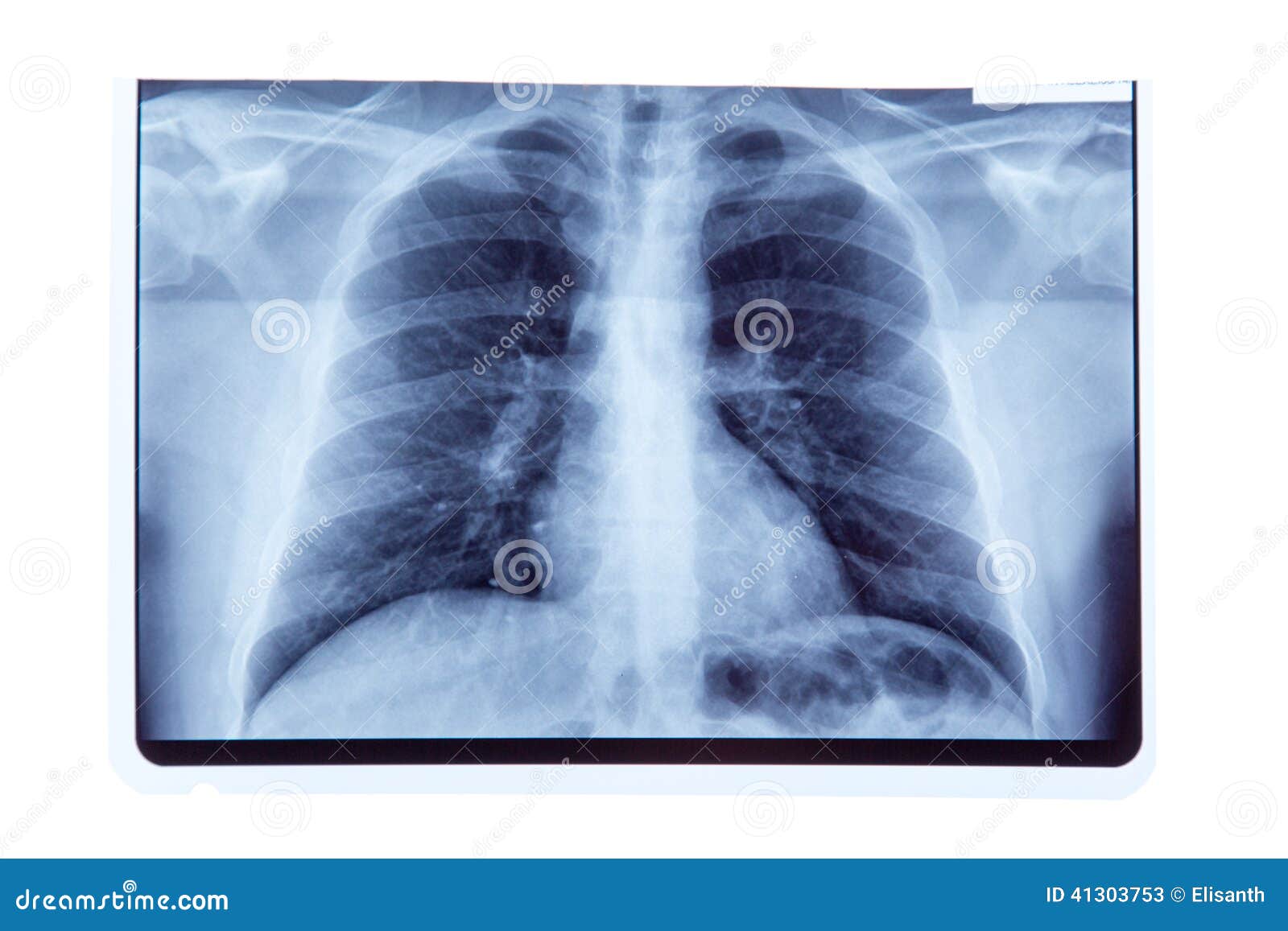 Lung Radiography Xray Result Stock Image Image of health, laboratory 41303753